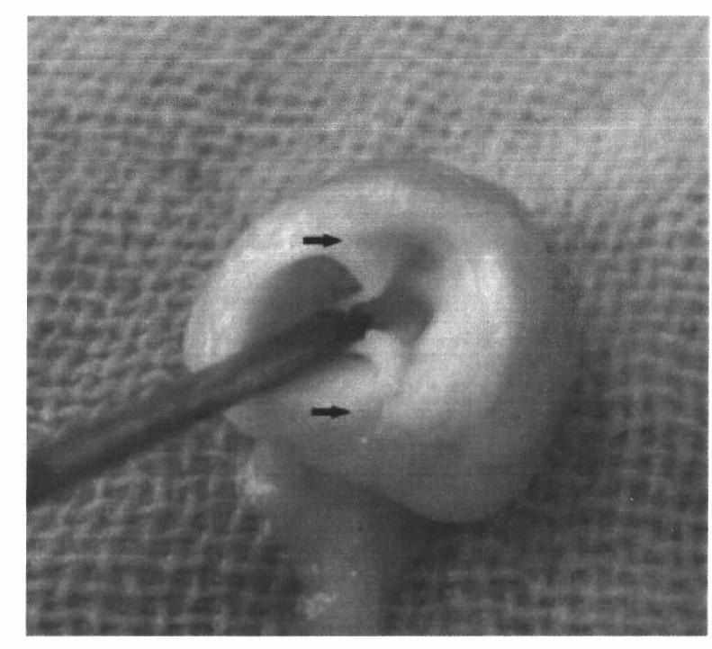 Establishment method of animal model for acute Stanford A-type aortic dissection (AD) accompanied with MODS (multiple organ dysfunction syndrome)