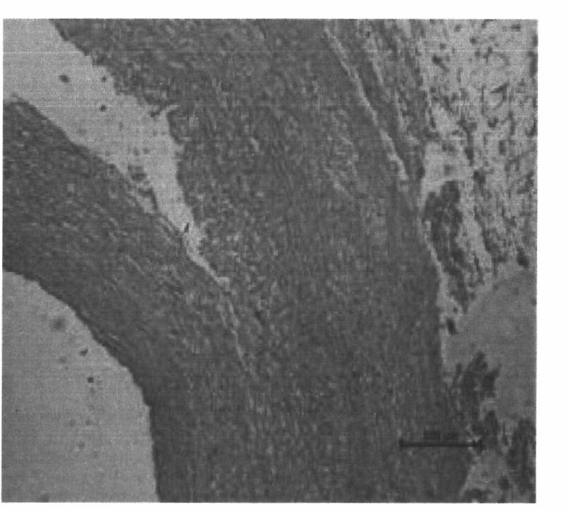 Establishment method of animal model for acute Stanford A-type aortic dissection (AD) accompanied with MODS (multiple organ dysfunction syndrome)