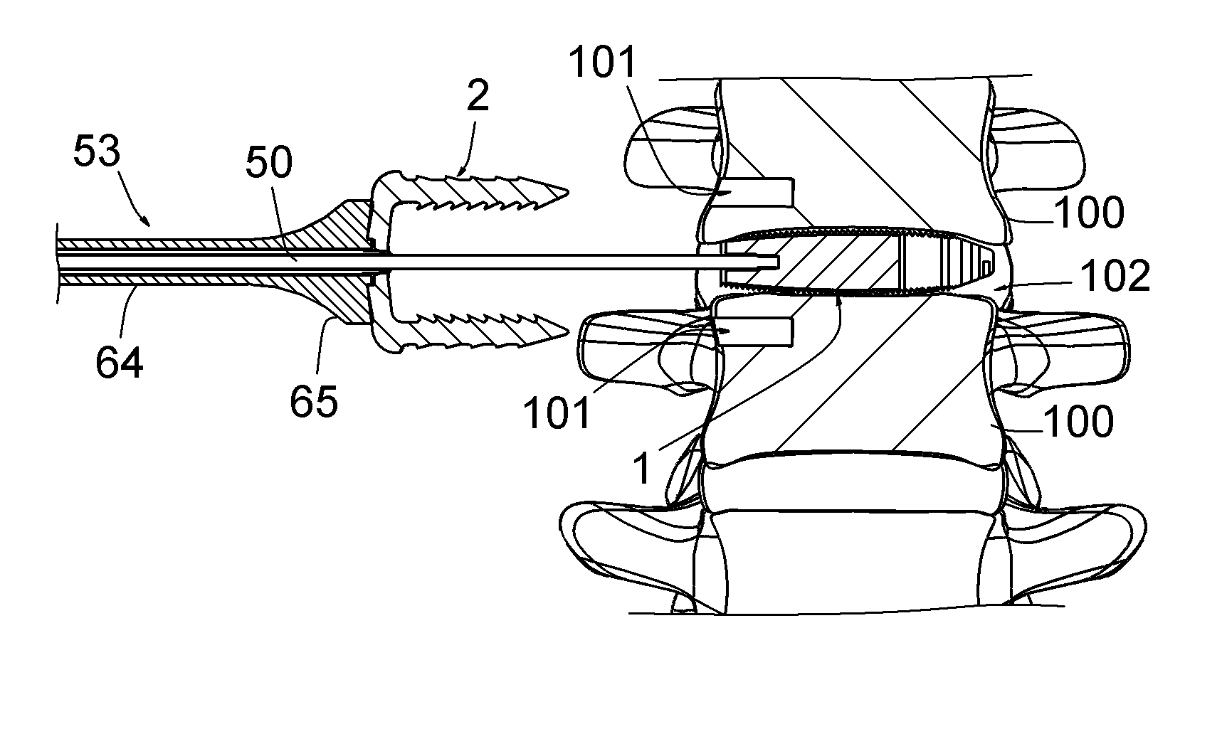 Vertebral osteosynthetis equipment