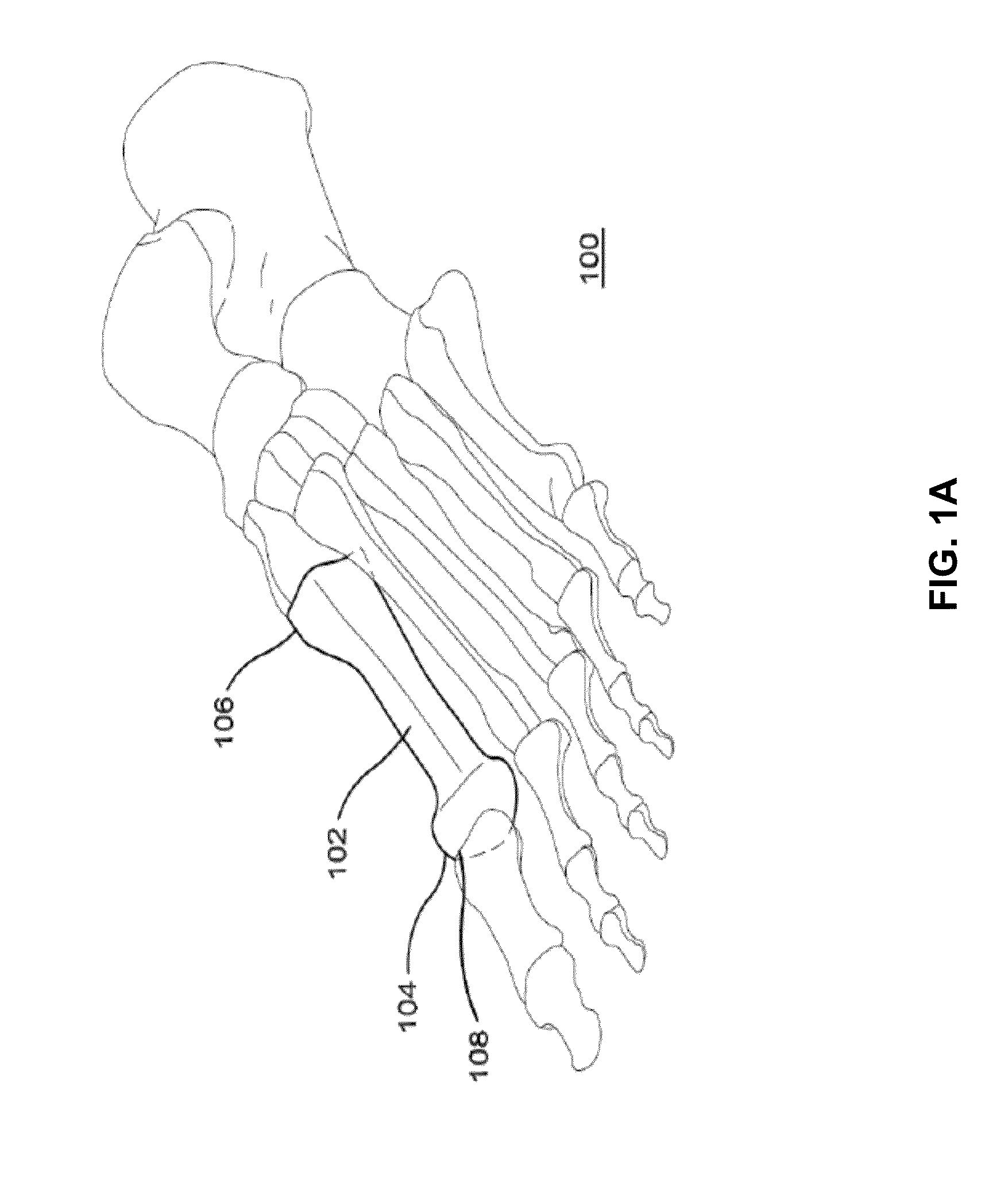 Bone fixation device and method