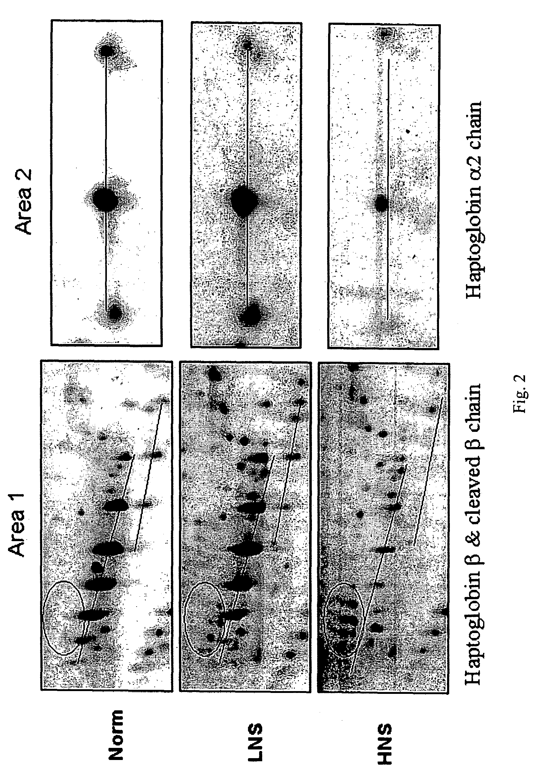 Serum biomarkers of Hepatitis B Virus infected liver and methods for detection thereof