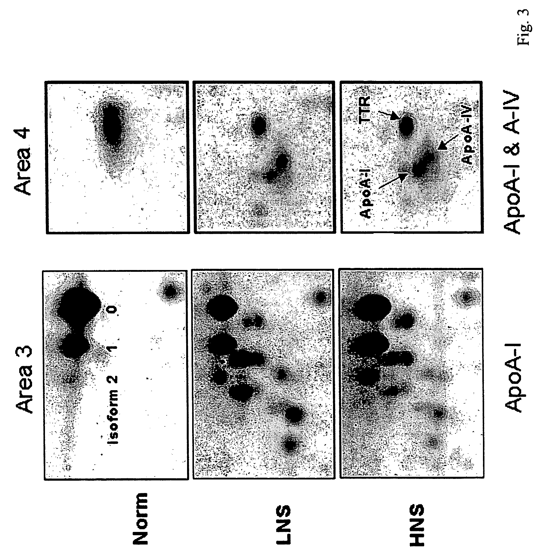 Serum biomarkers of Hepatitis B Virus infected liver and methods for detection thereof