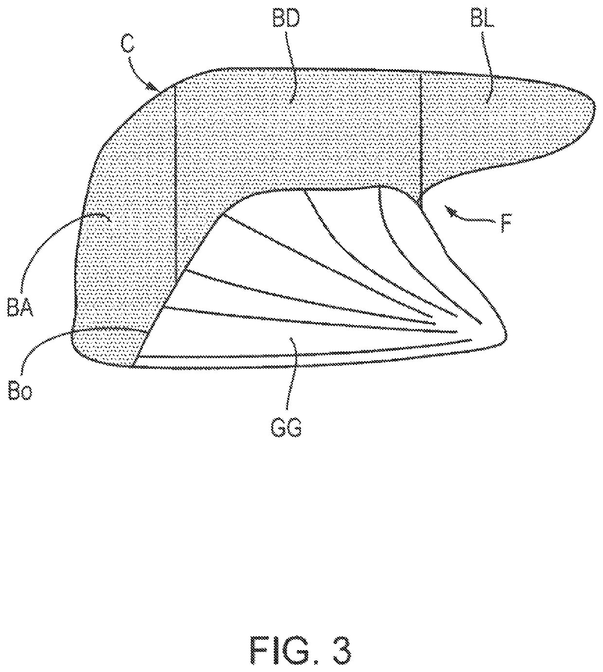 Methods and devices for treating sleep apnea and snoring