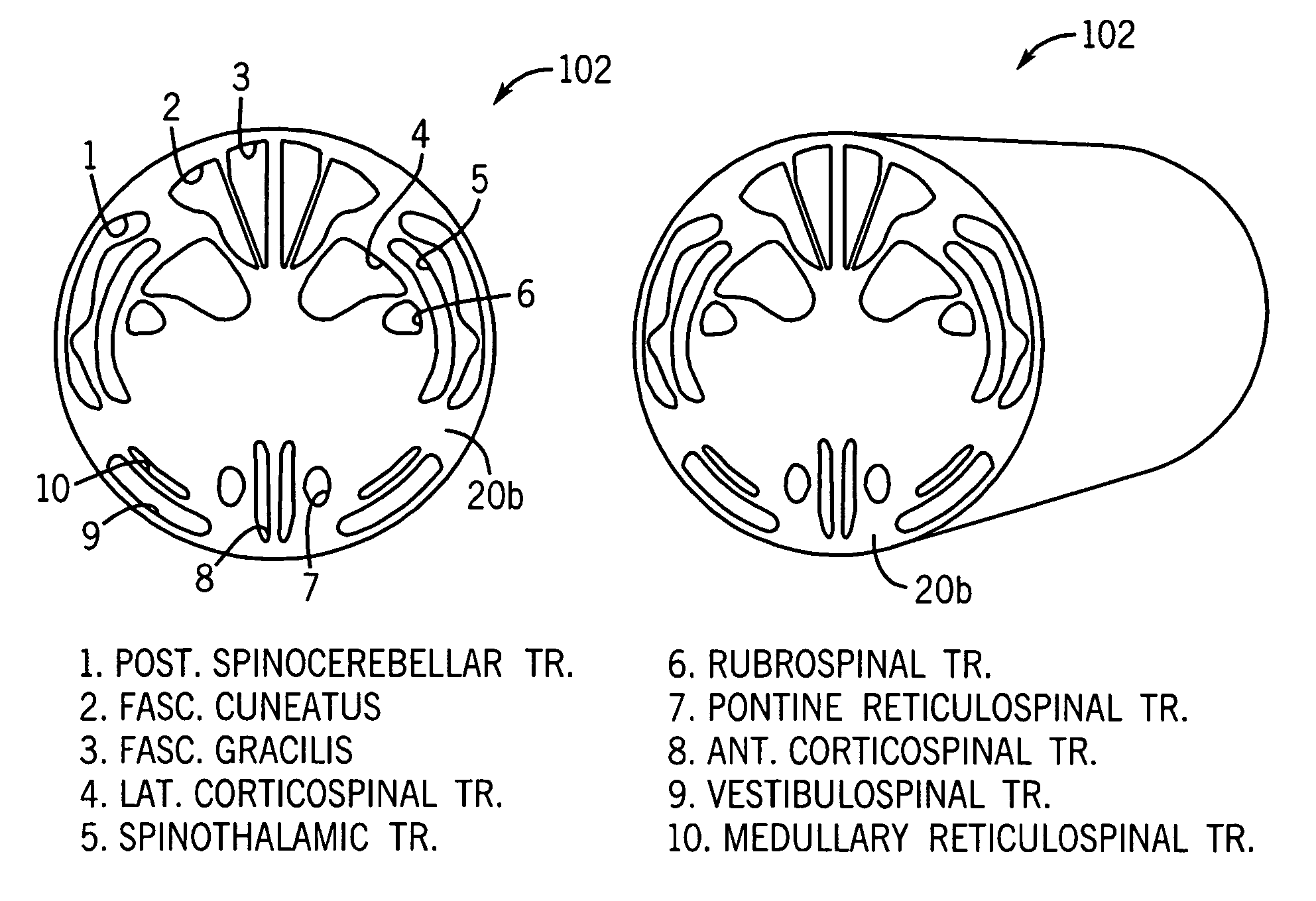 Spinal cord surgical implant