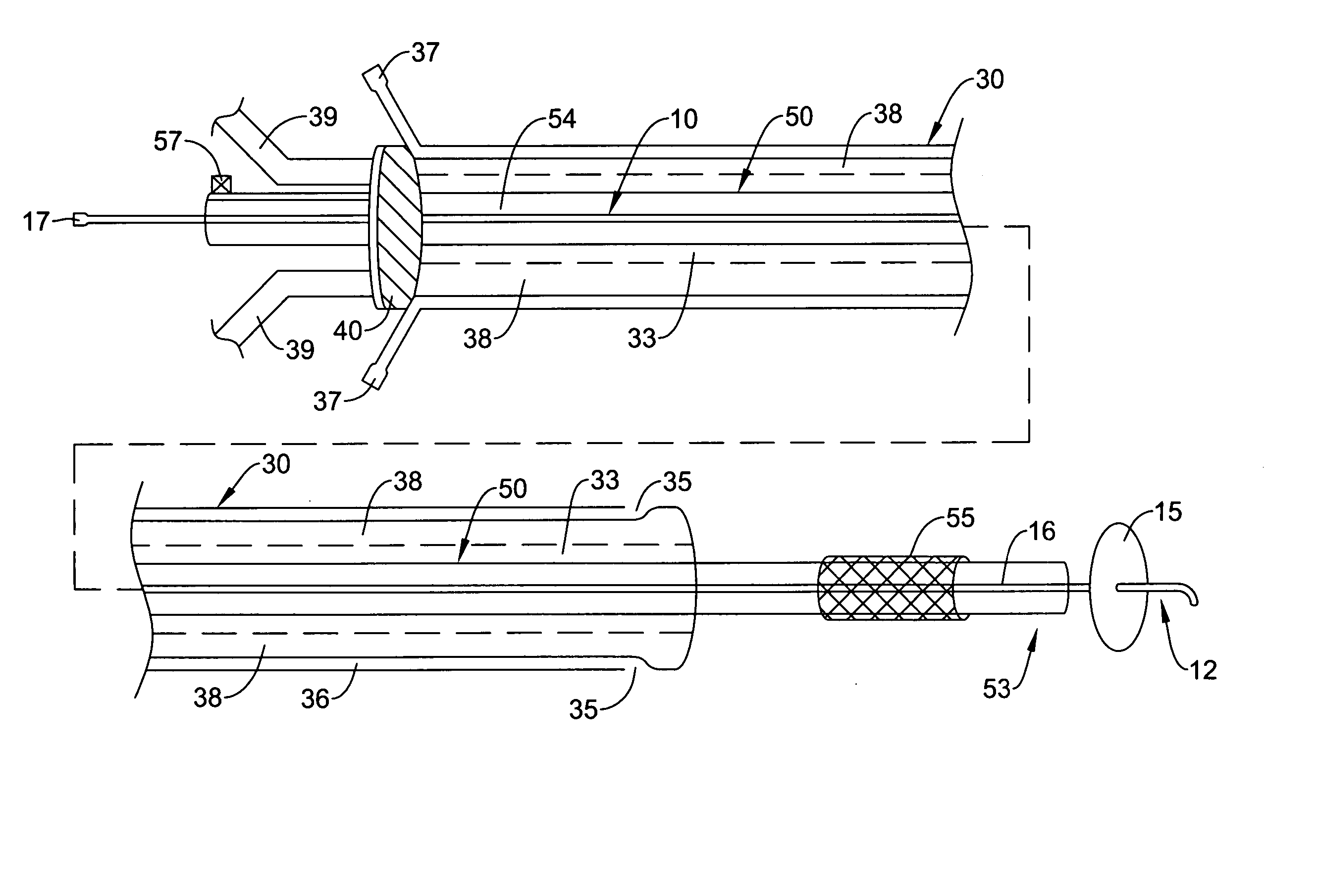 Endoluminal occlusion-irrigation catheter with aspiration capabilities and methods of use