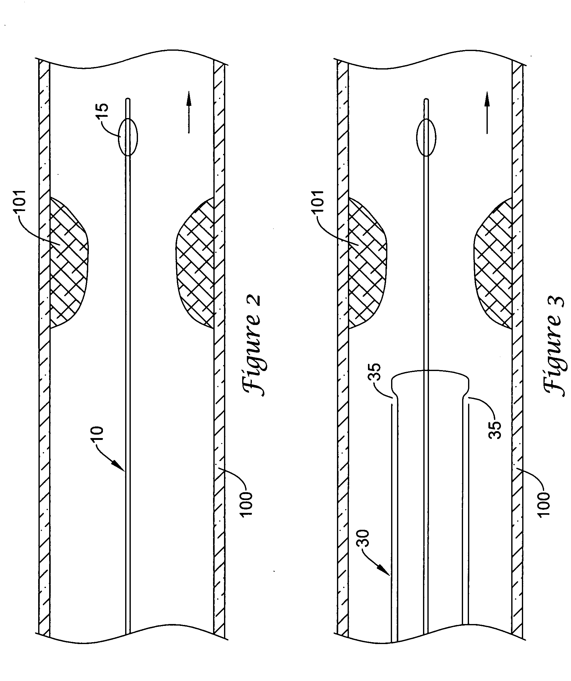 Endoluminal occlusion-irrigation catheter with aspiration capabilities and methods of use