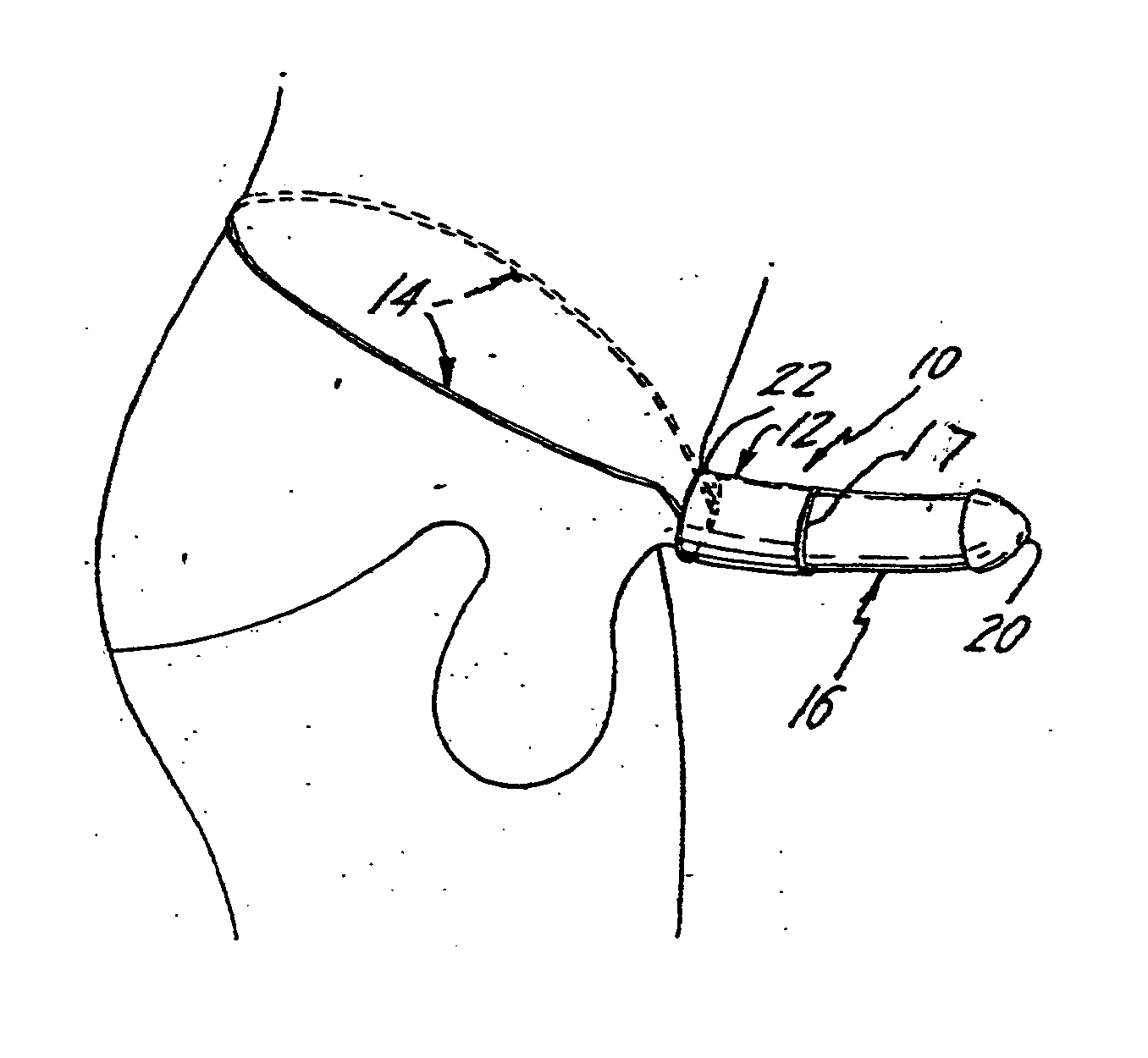 Penile foreskin restraining device and method