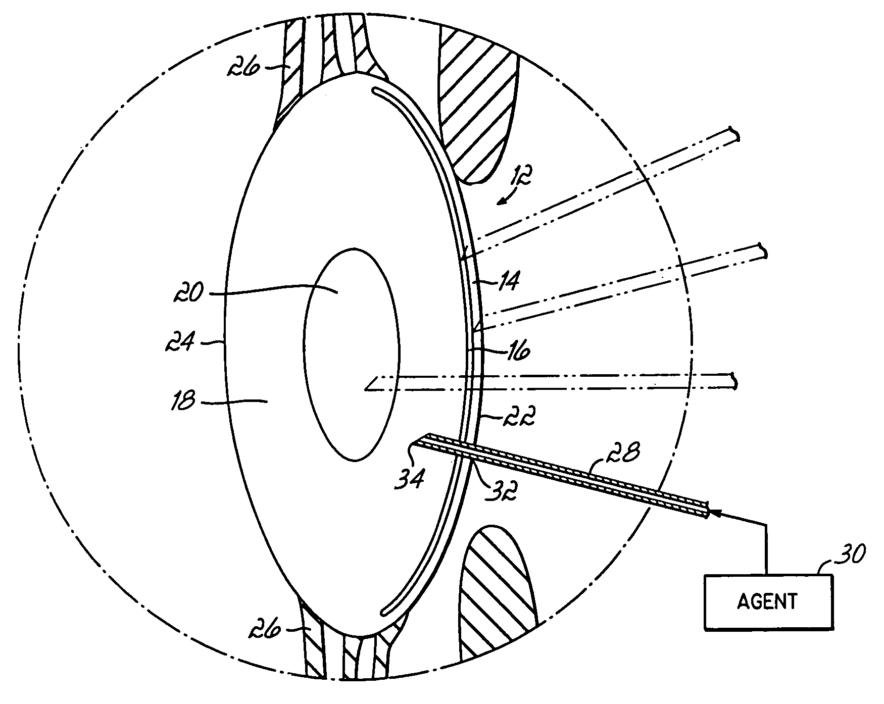 Crystalline lens drug delivery