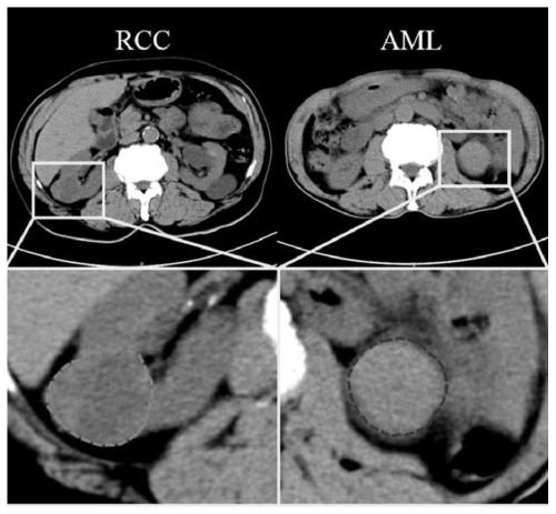 Kidney lump classification method based on random projection