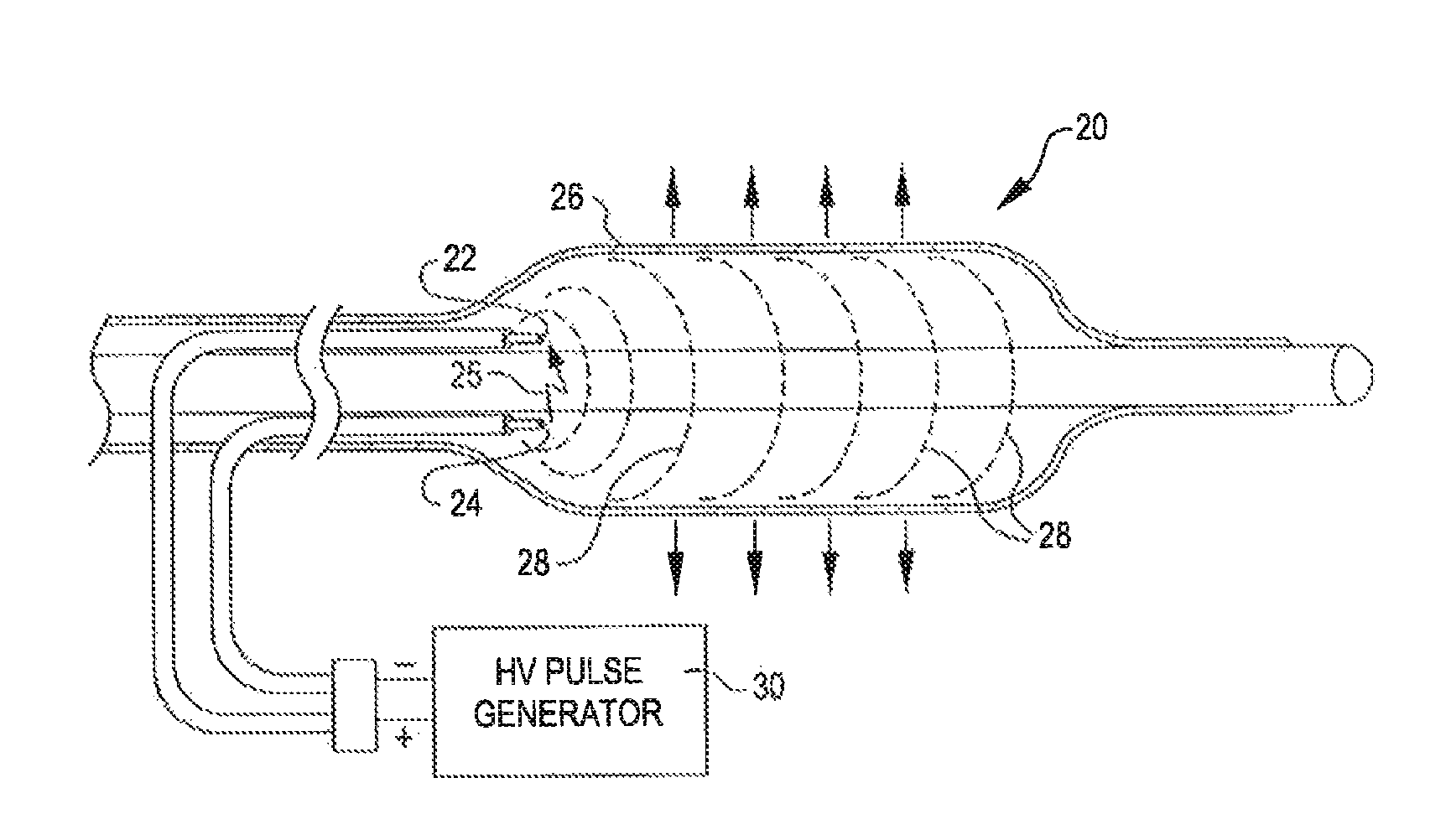 Non-cavitation shockwave balloon catheter system