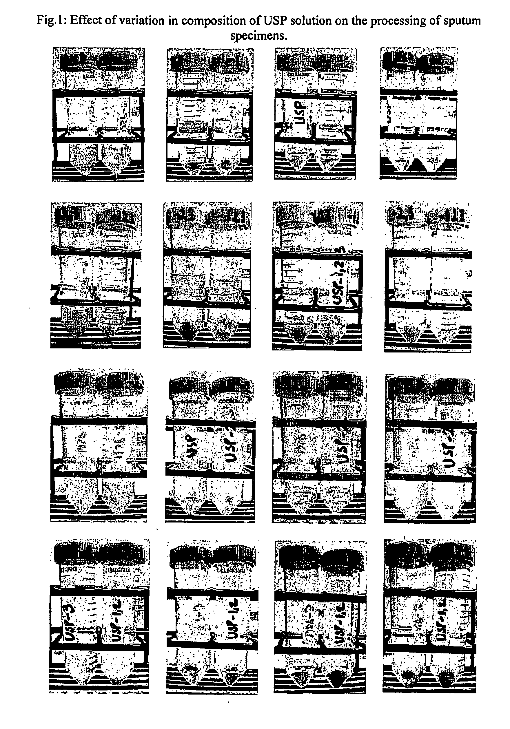 Method for diagnosis of tuberculosis by smear microscopy, culture and polymerase chain reaction using processed clinical samples and kit thereof