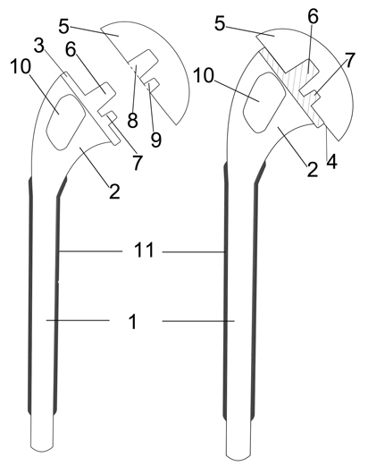 Design method for tantalum coating artificial shoulder prosthesis