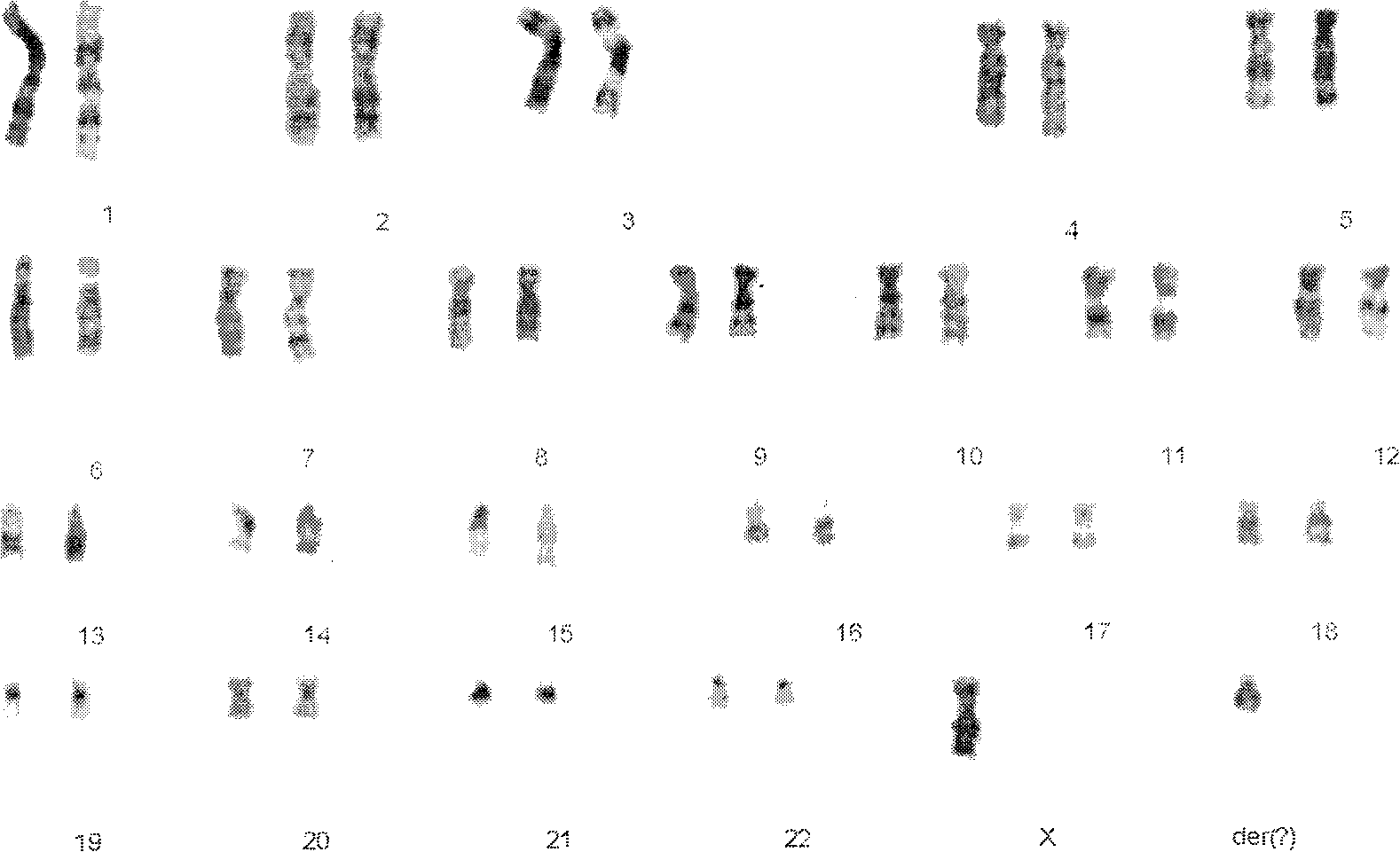 Method for preparing birth defect target oligonucleotide microarray comparative genomic hybridization hybrid chip