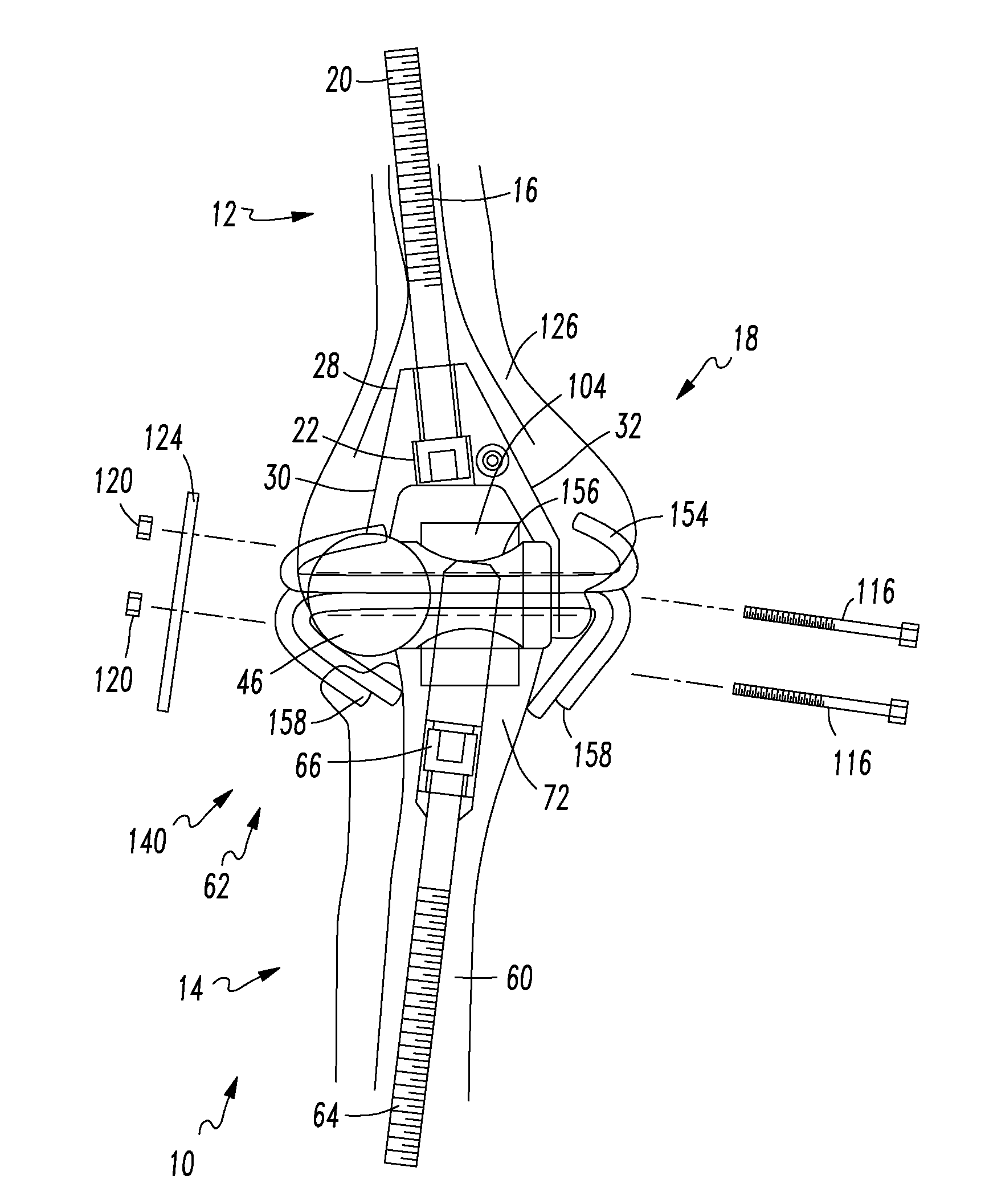 Prosthesis for Partial and Total Joint Replacement