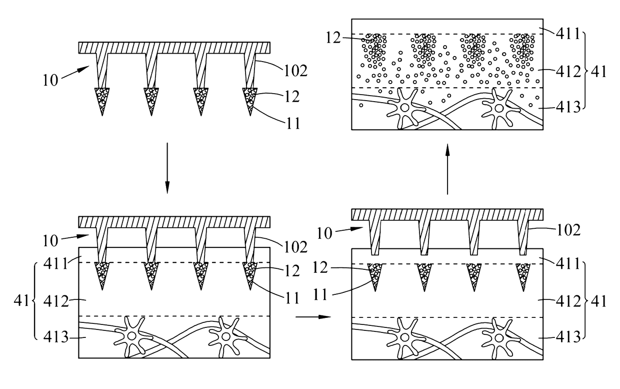 Embeddable micro-needle patch for transdermal drug delivery and method of manufacturing the same