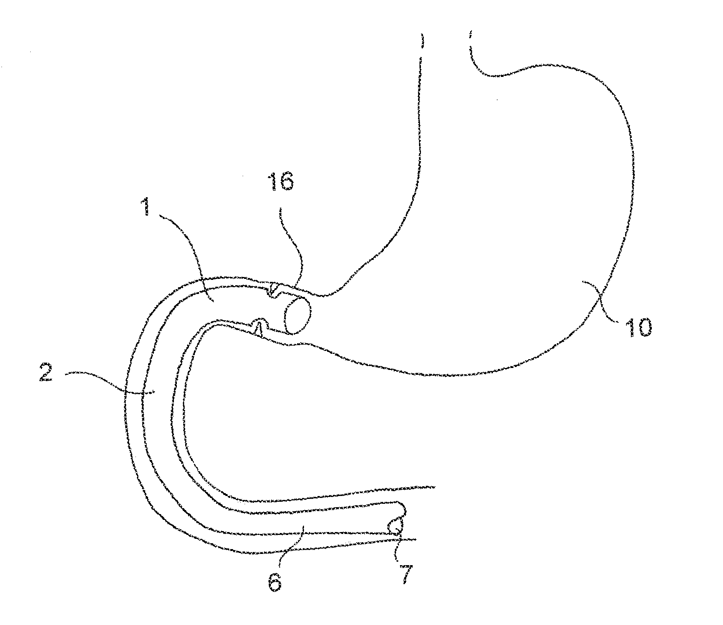 Device for Anchoring an Endoluminal Sleeve in the GI Tract