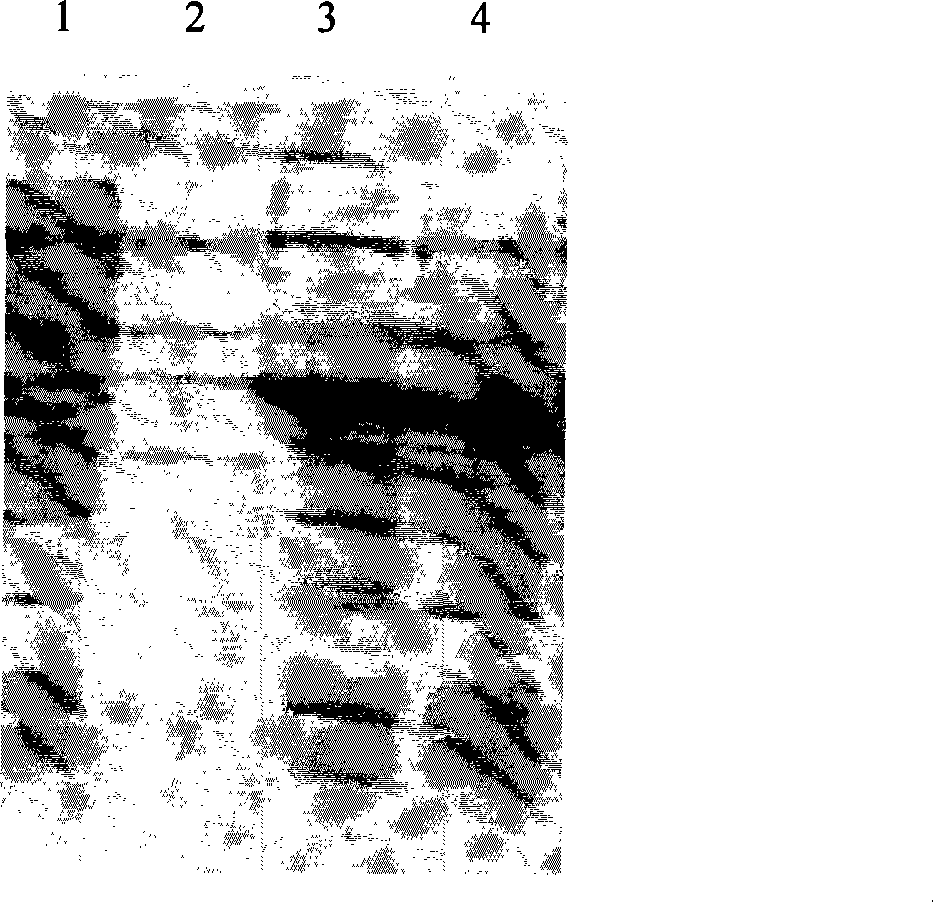 Recombinant expression of human desmocyte growth factor-21