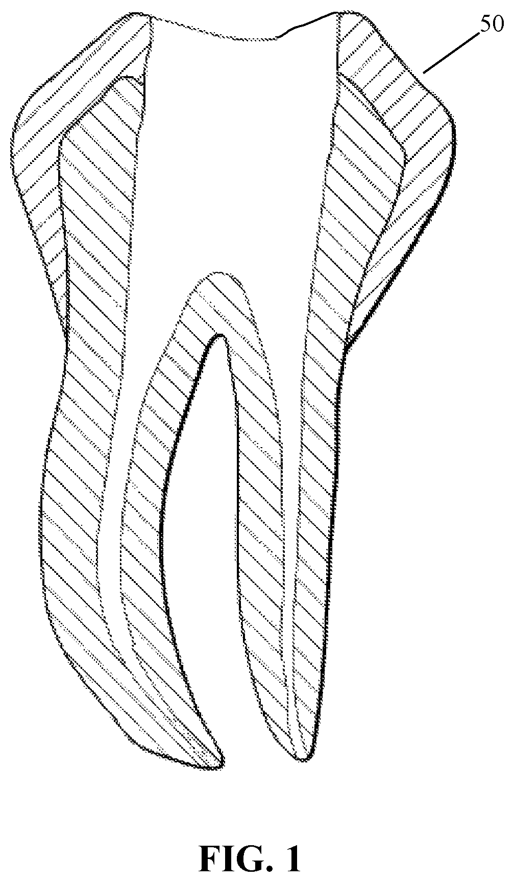 Method and extraction device for removal of broken root canal file fragment