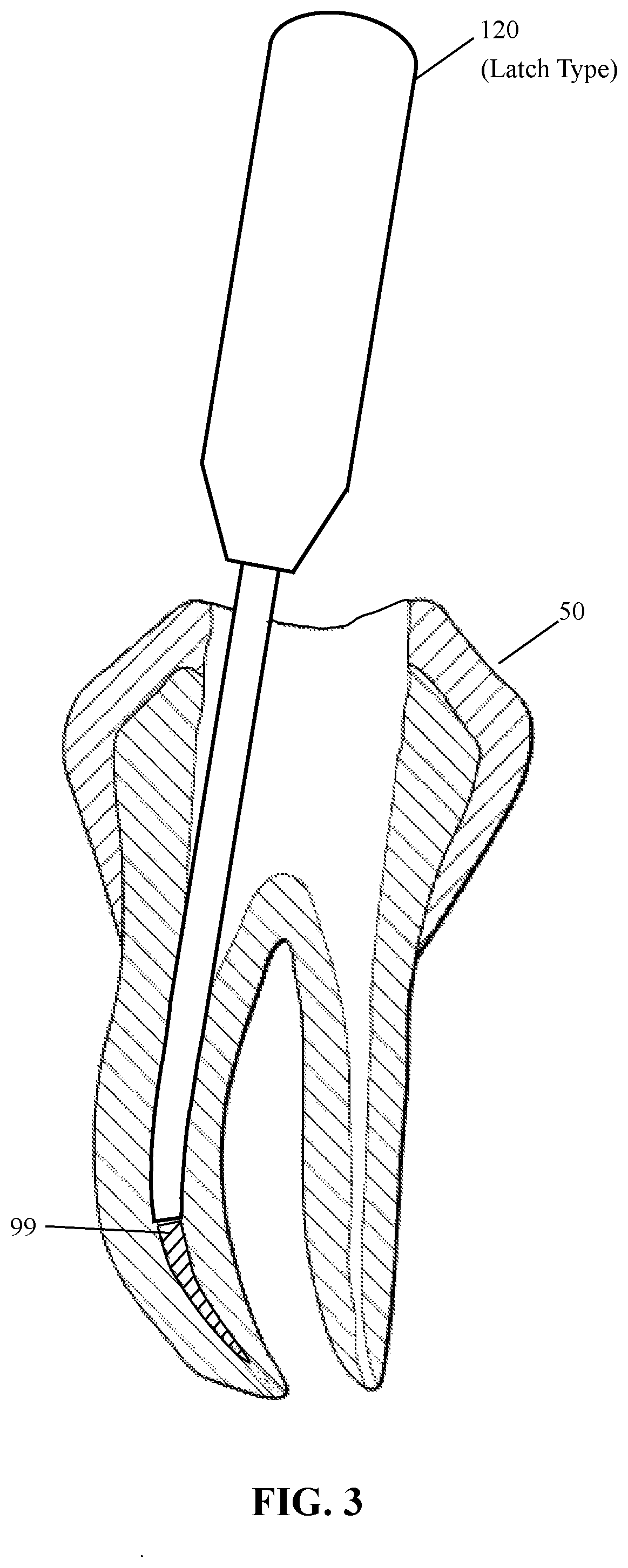 Method and extraction device for removal of broken root canal file fragment