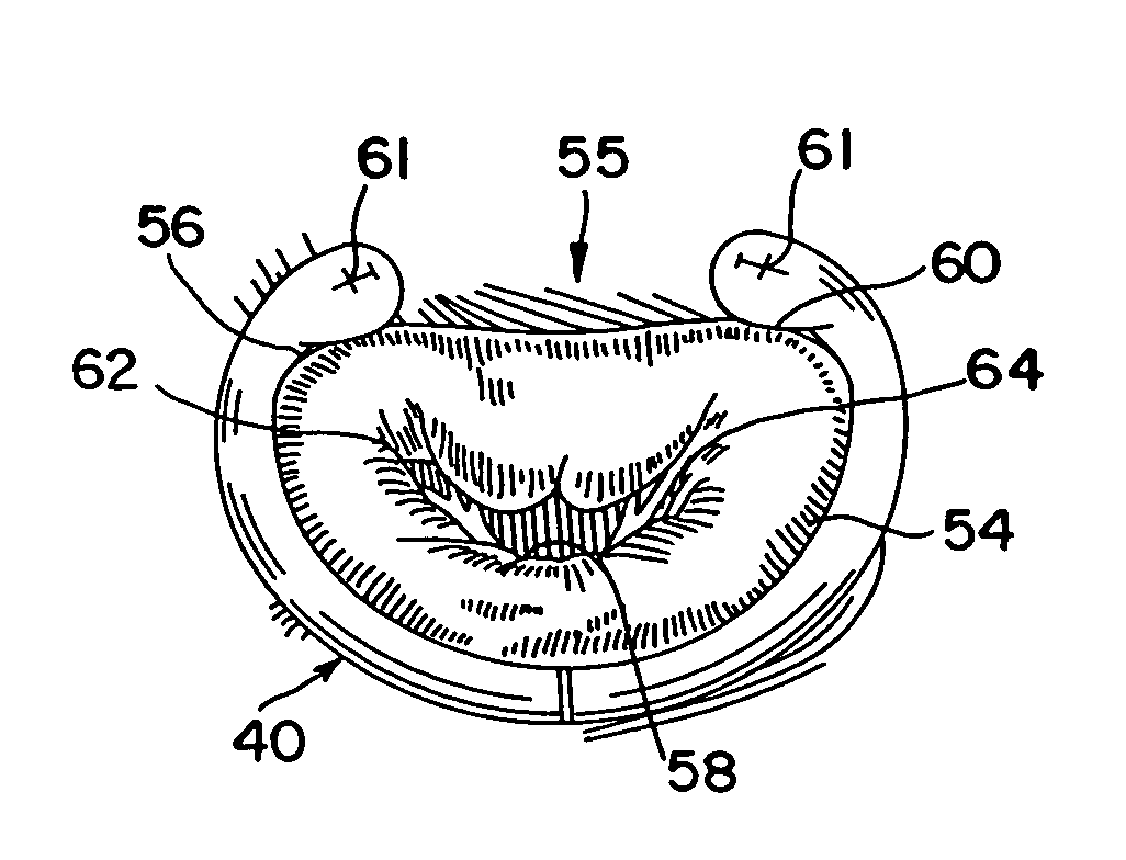 Implantable prosthesis