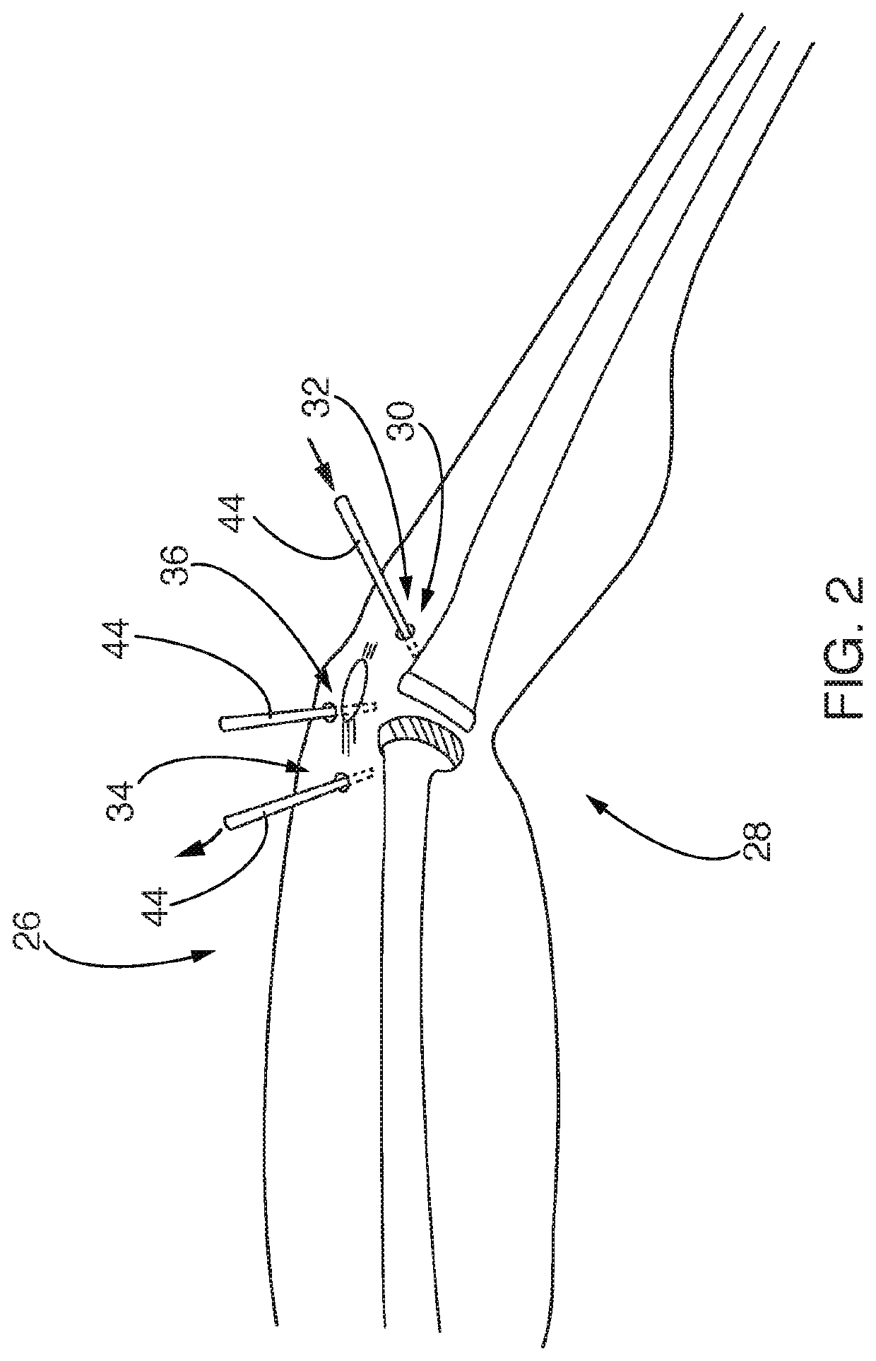 Systems and methods for reducing contaminants in a portion of a patient