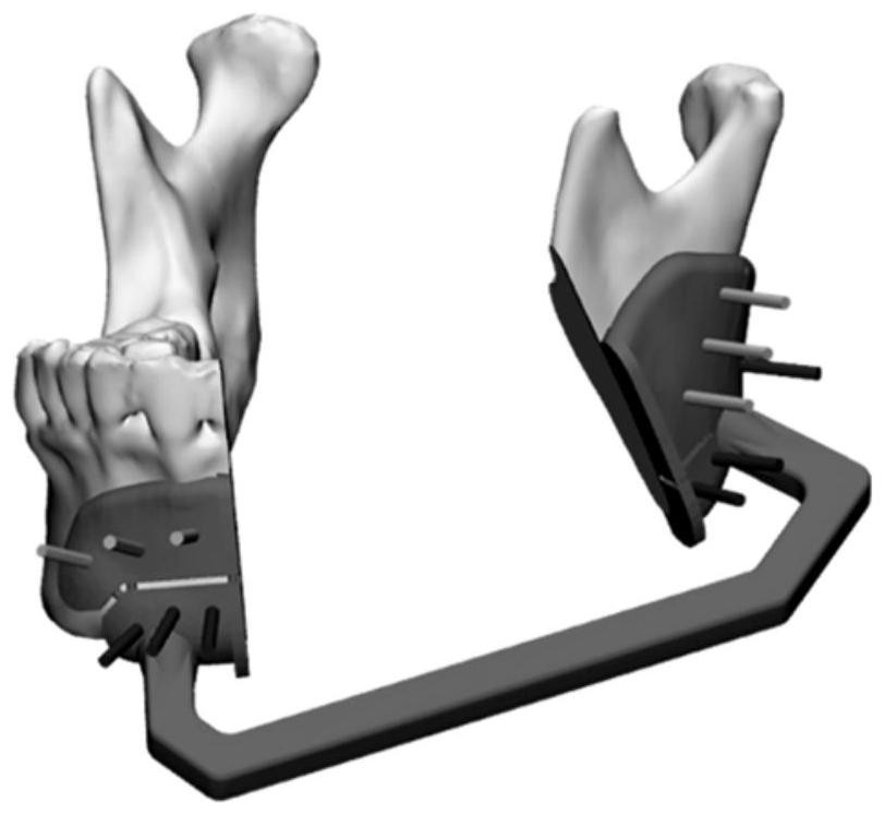 Integrated mandible osteotomy external fixing device and use method