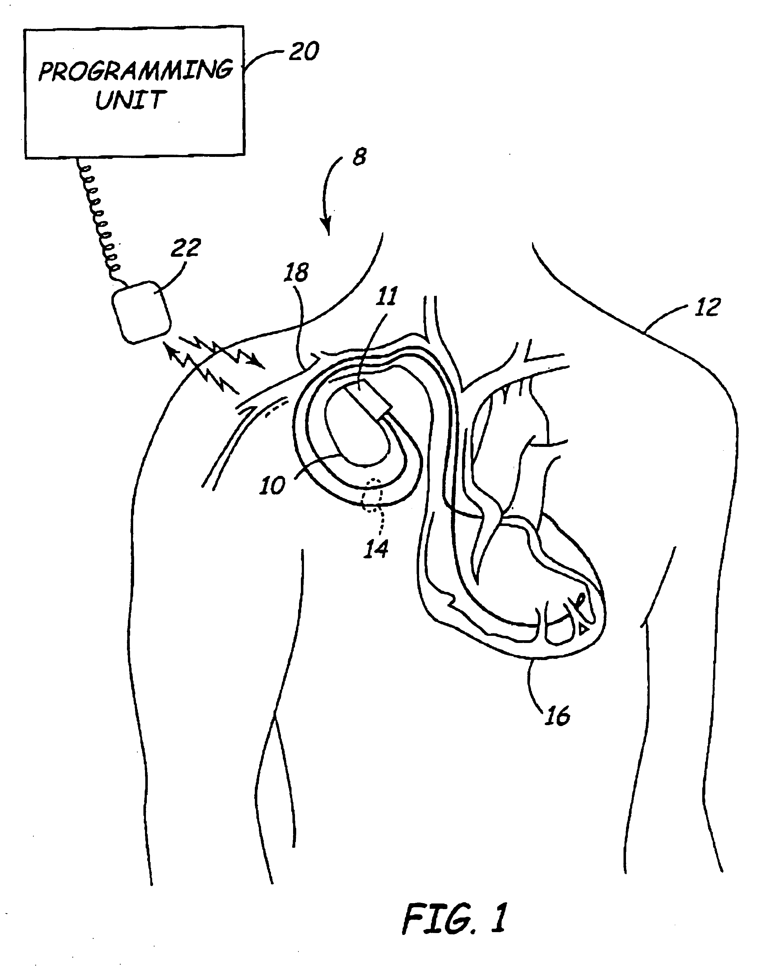 Method for stacking semiconductor die within an implanted medical device