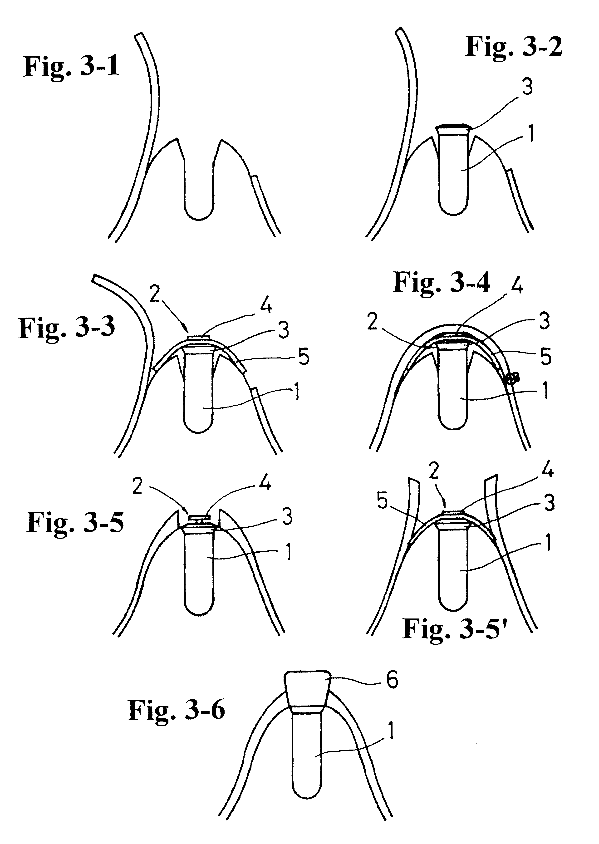 Cover screw for dental implant