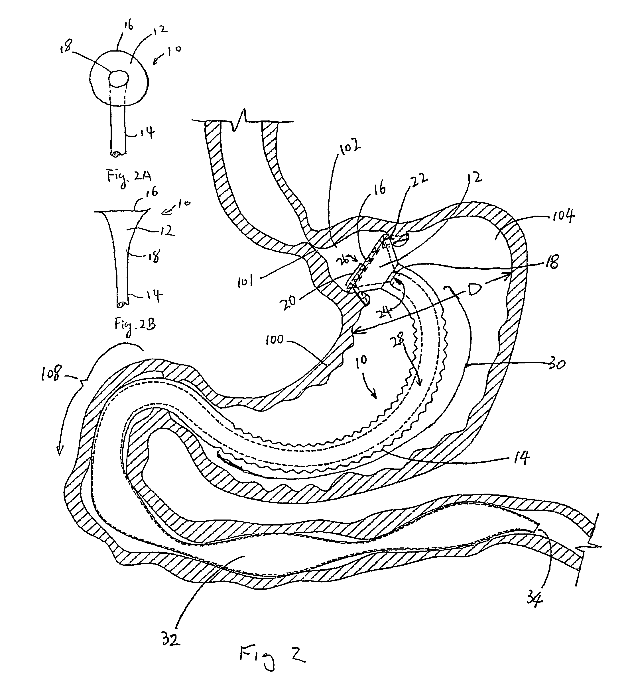 Gastric bypass prosthesis