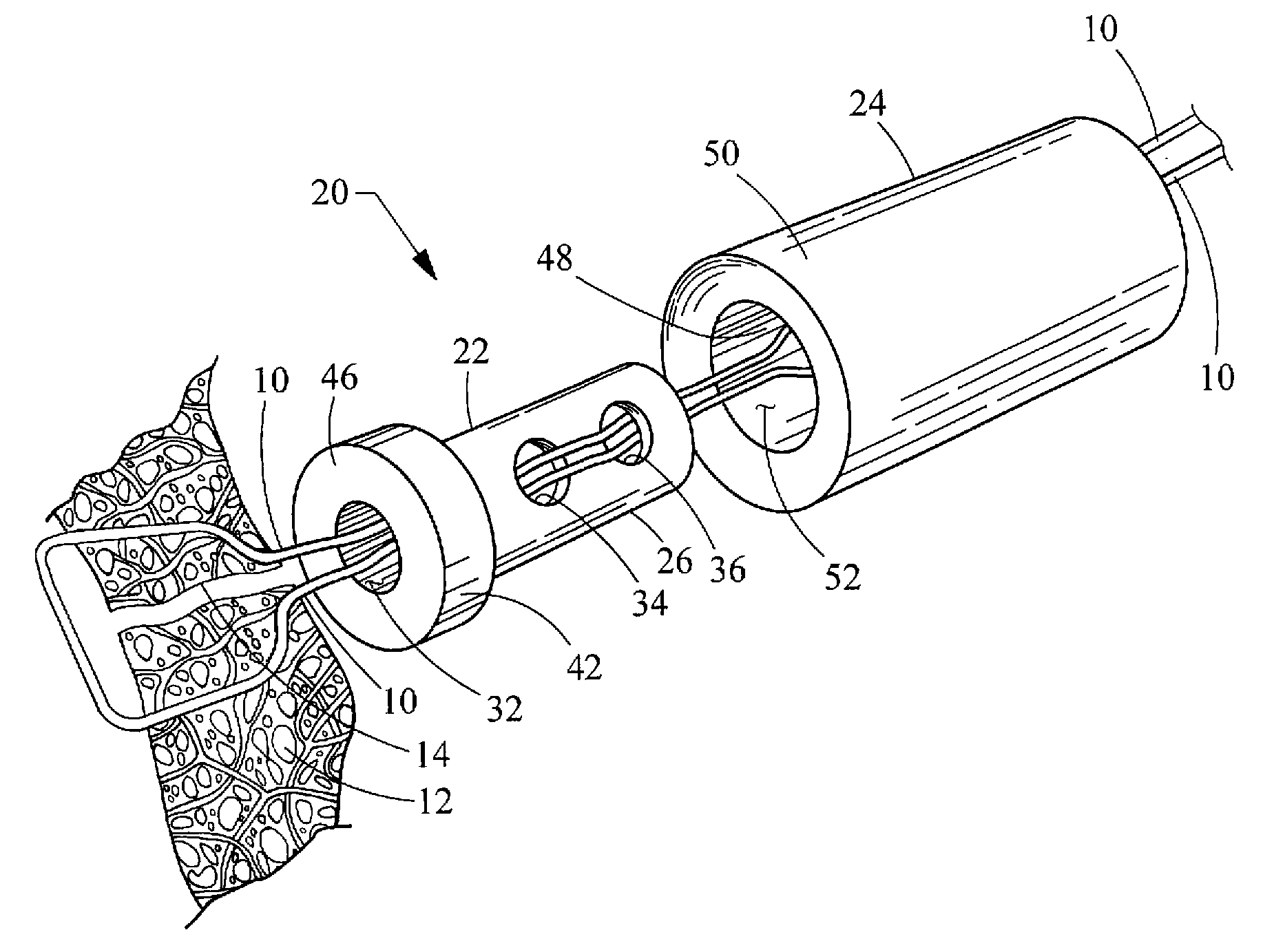 Suture lock