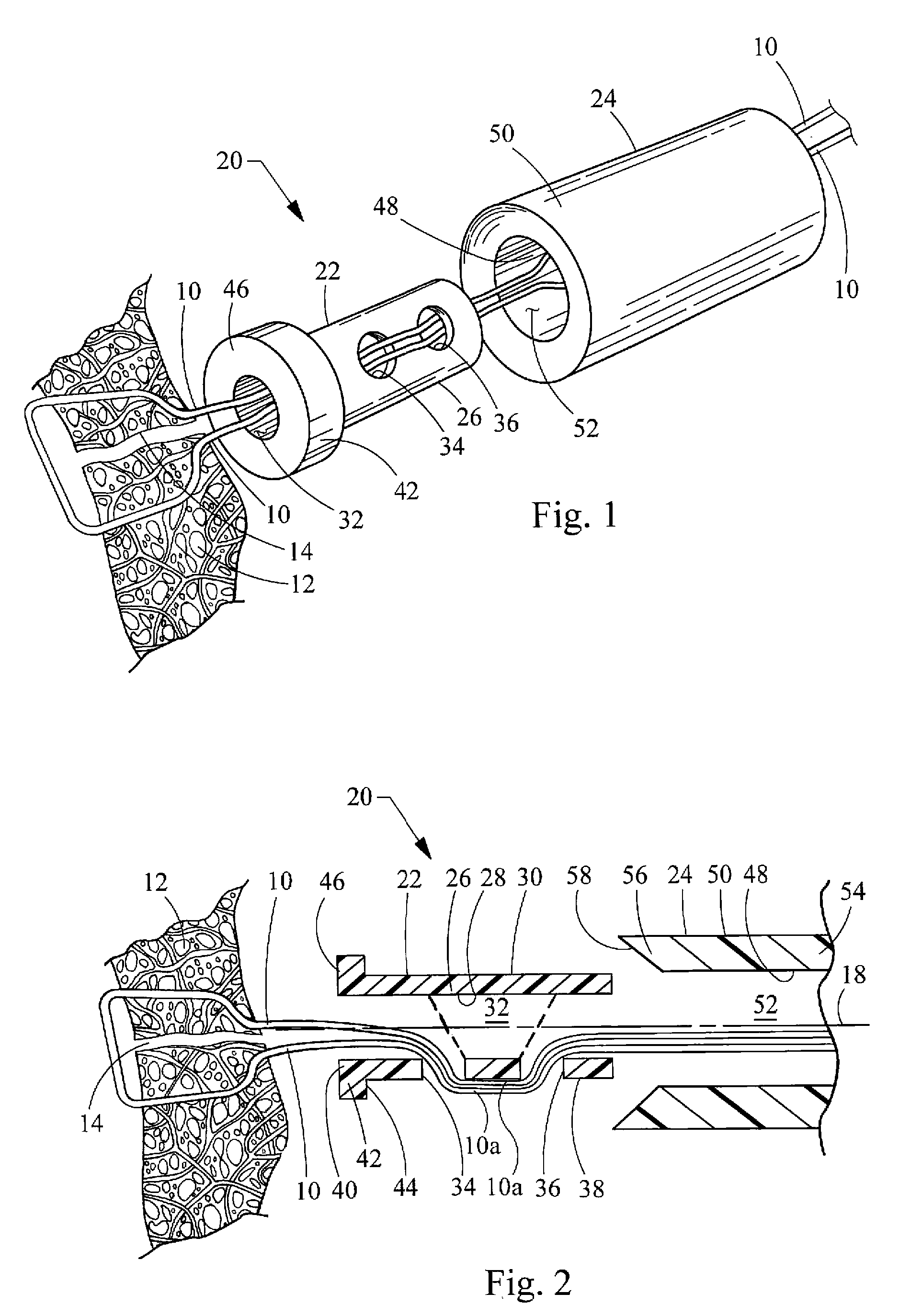 Suture lock