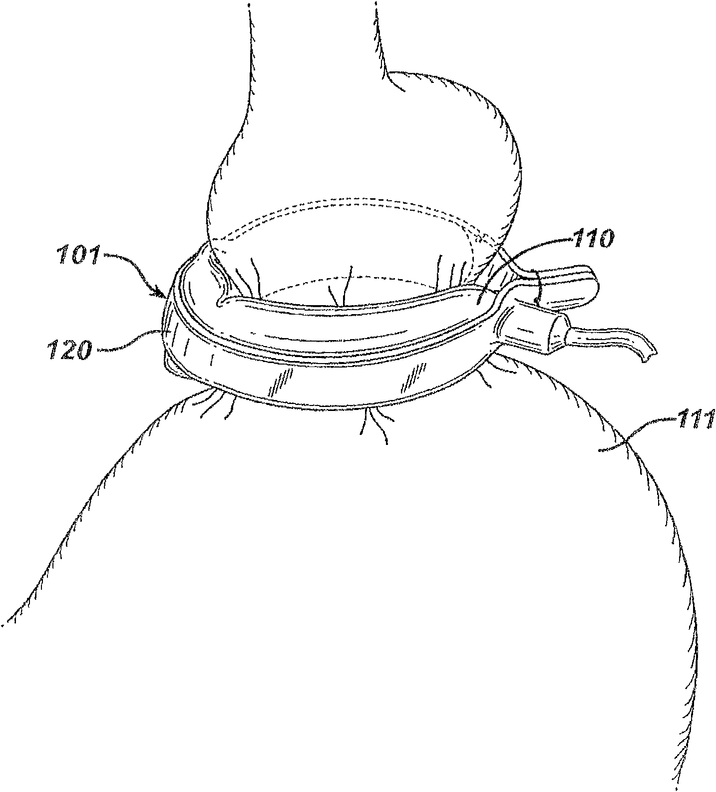 A surgically implantable injection port having a centered catheter connection tube