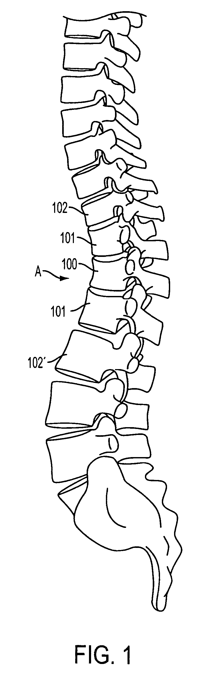 Device for dynamic spinal fixation for correction of spinal deformities