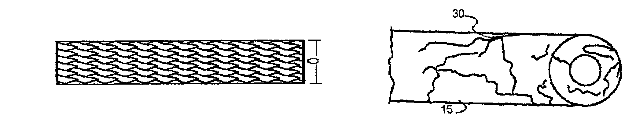 Balloon expandable polymer stent with reduced elastic recoil