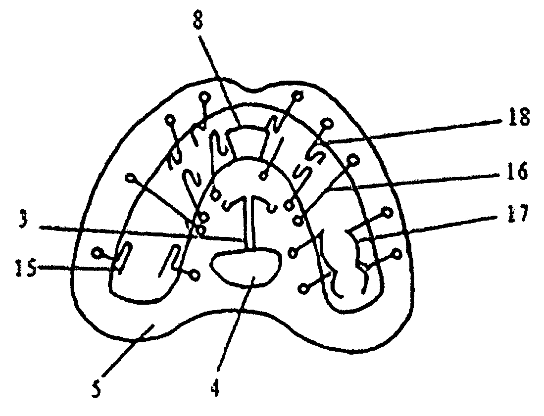 Removable intra-oral corrective anti-snoring device