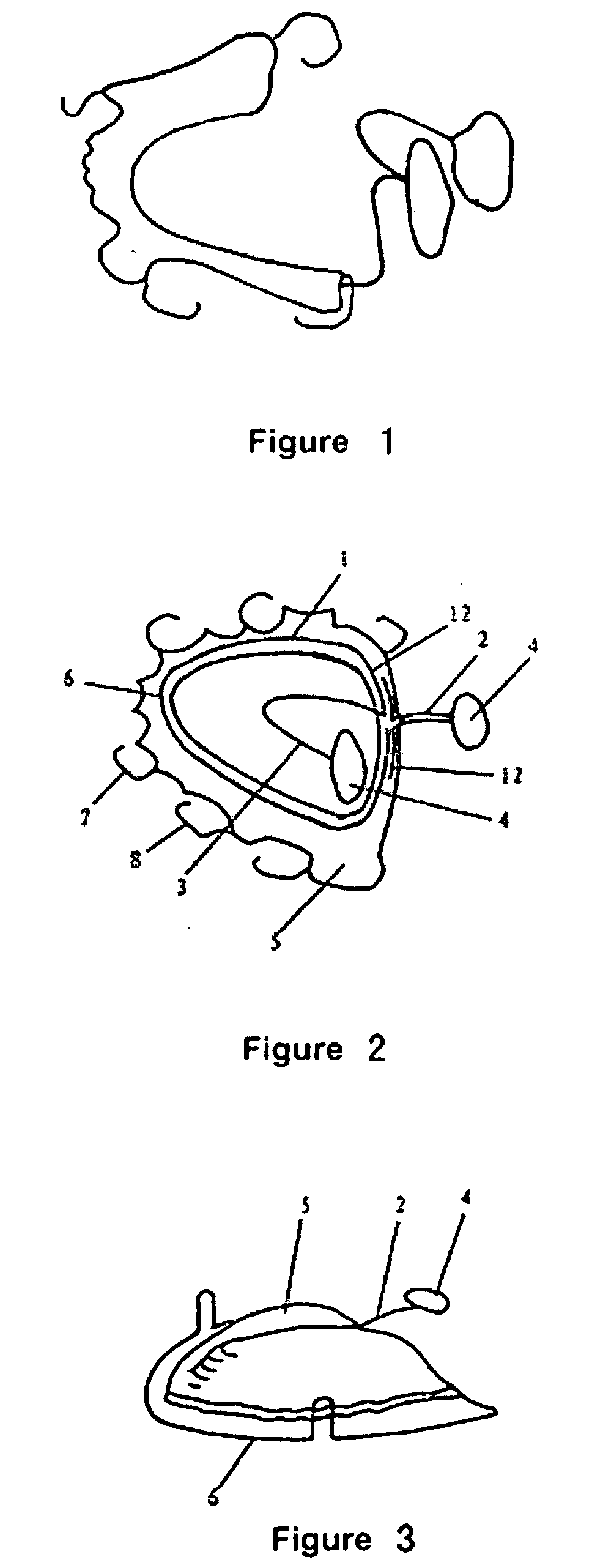 Removable intra-oral corrective anti-snoring device