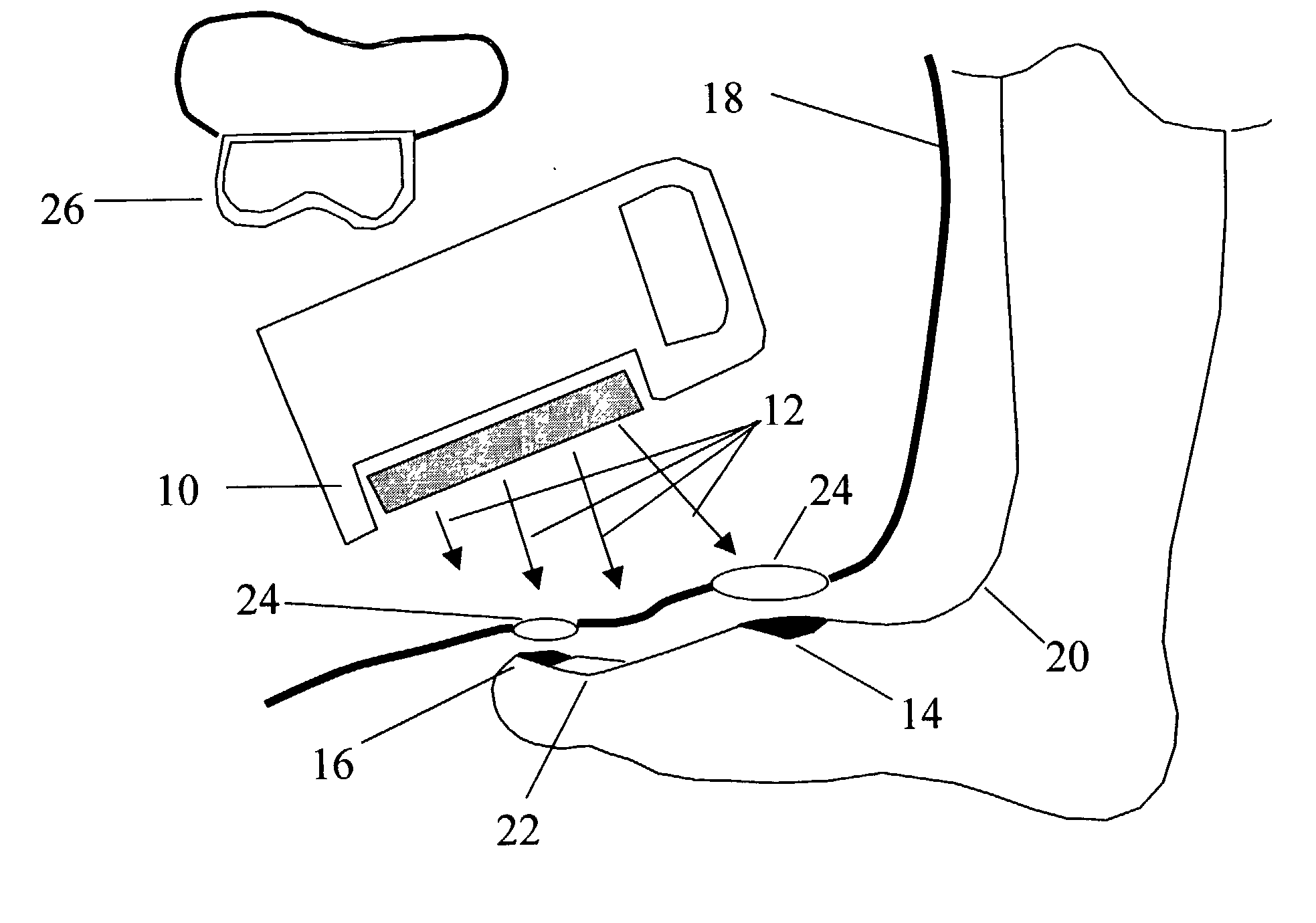 Method for the prevention and treatment of skin and nail infections