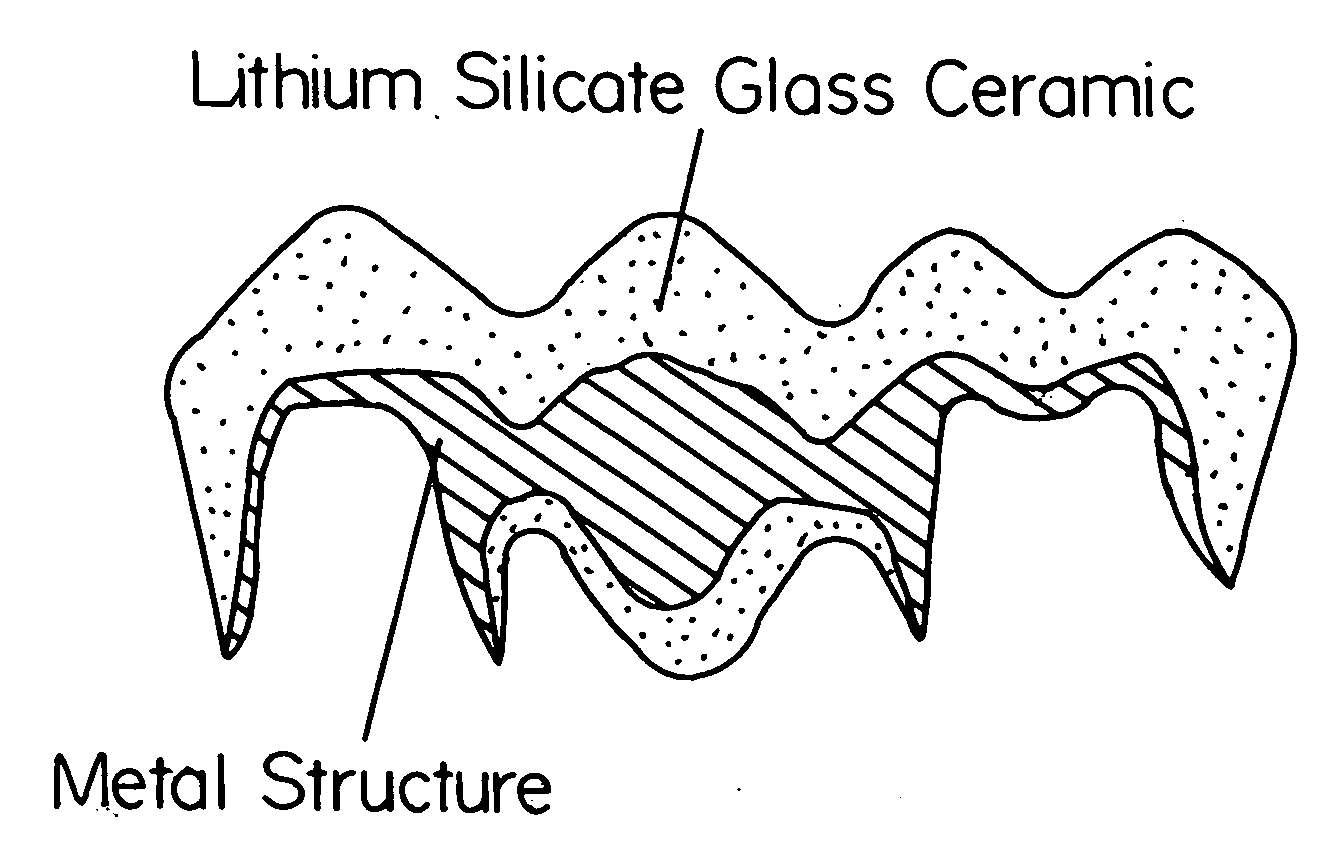 Indirect restoration technology