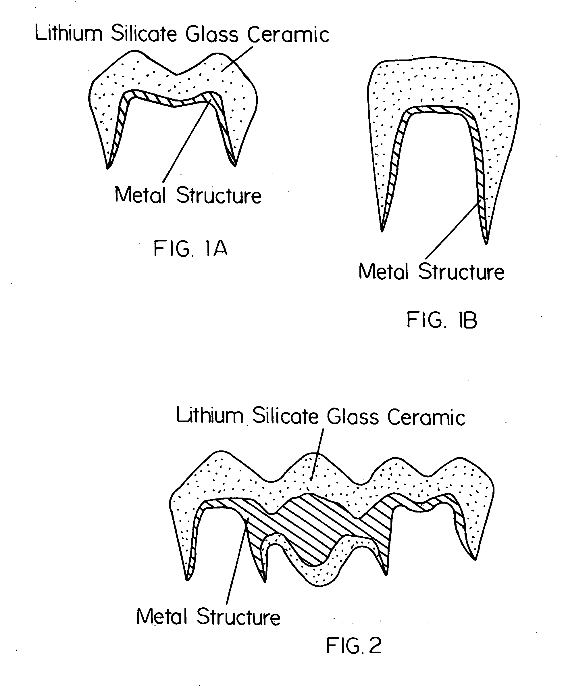 Indirect restoration technology