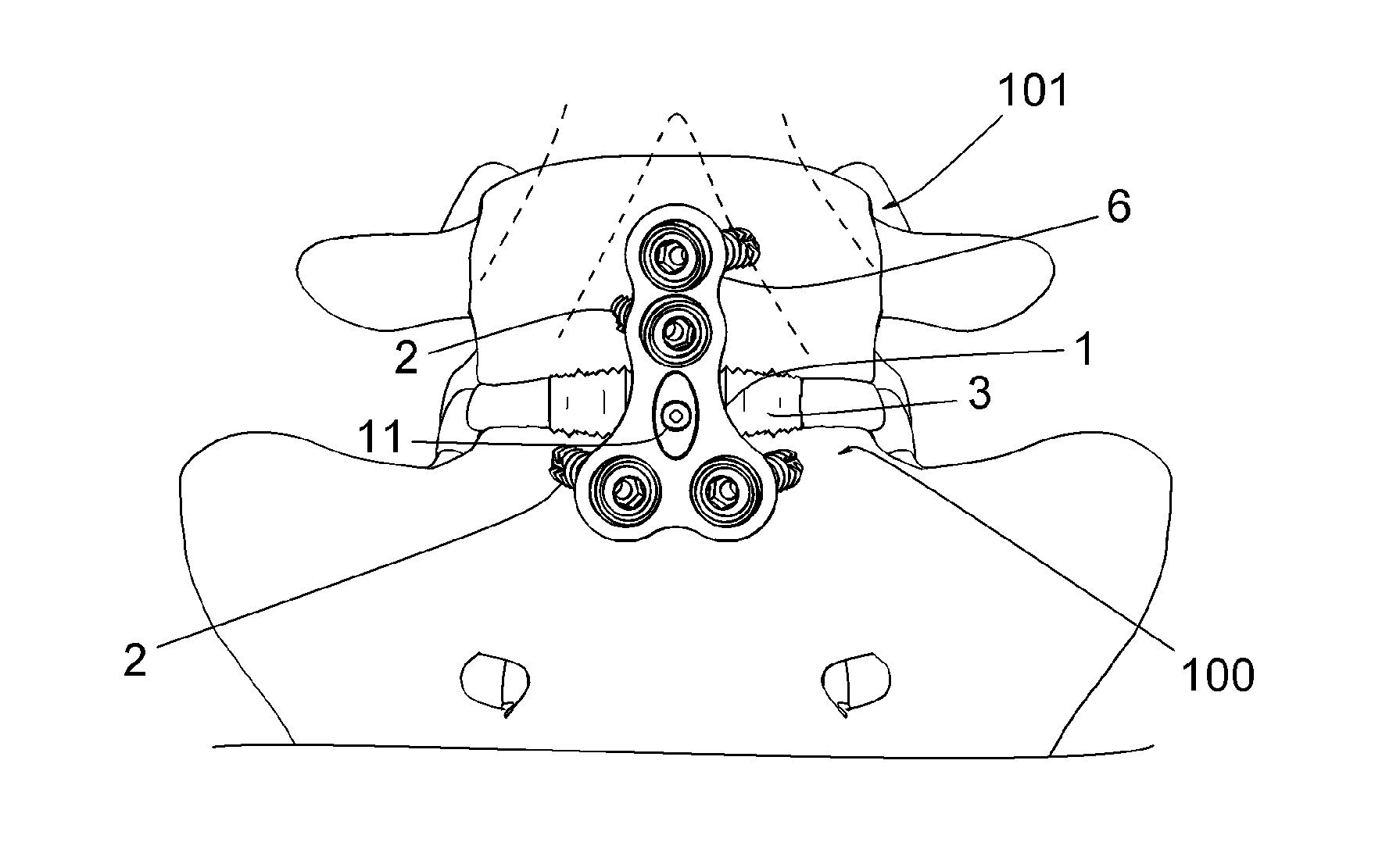 Osteosynthesis plate for lumbosacral joint