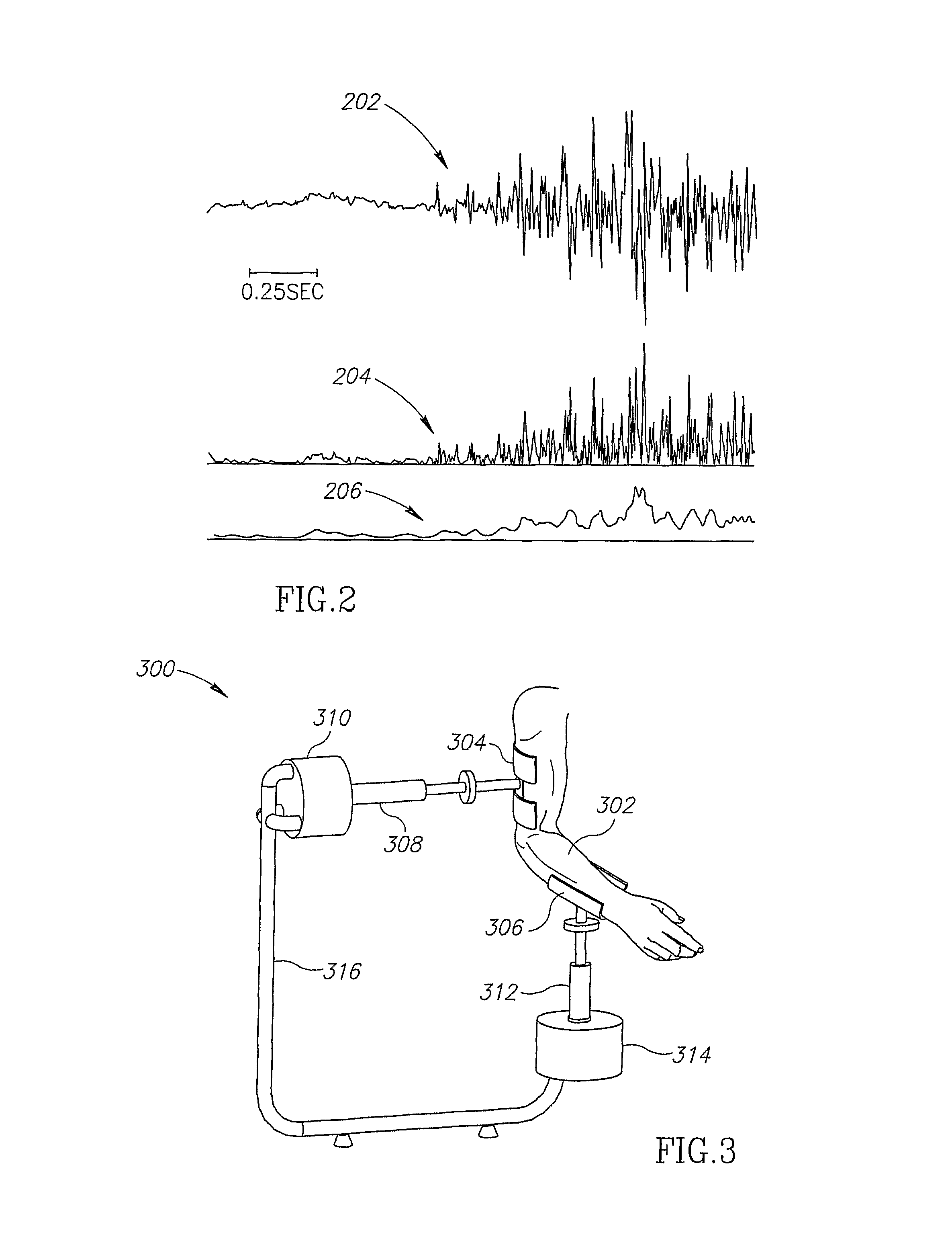 Neuromuscular stimulation