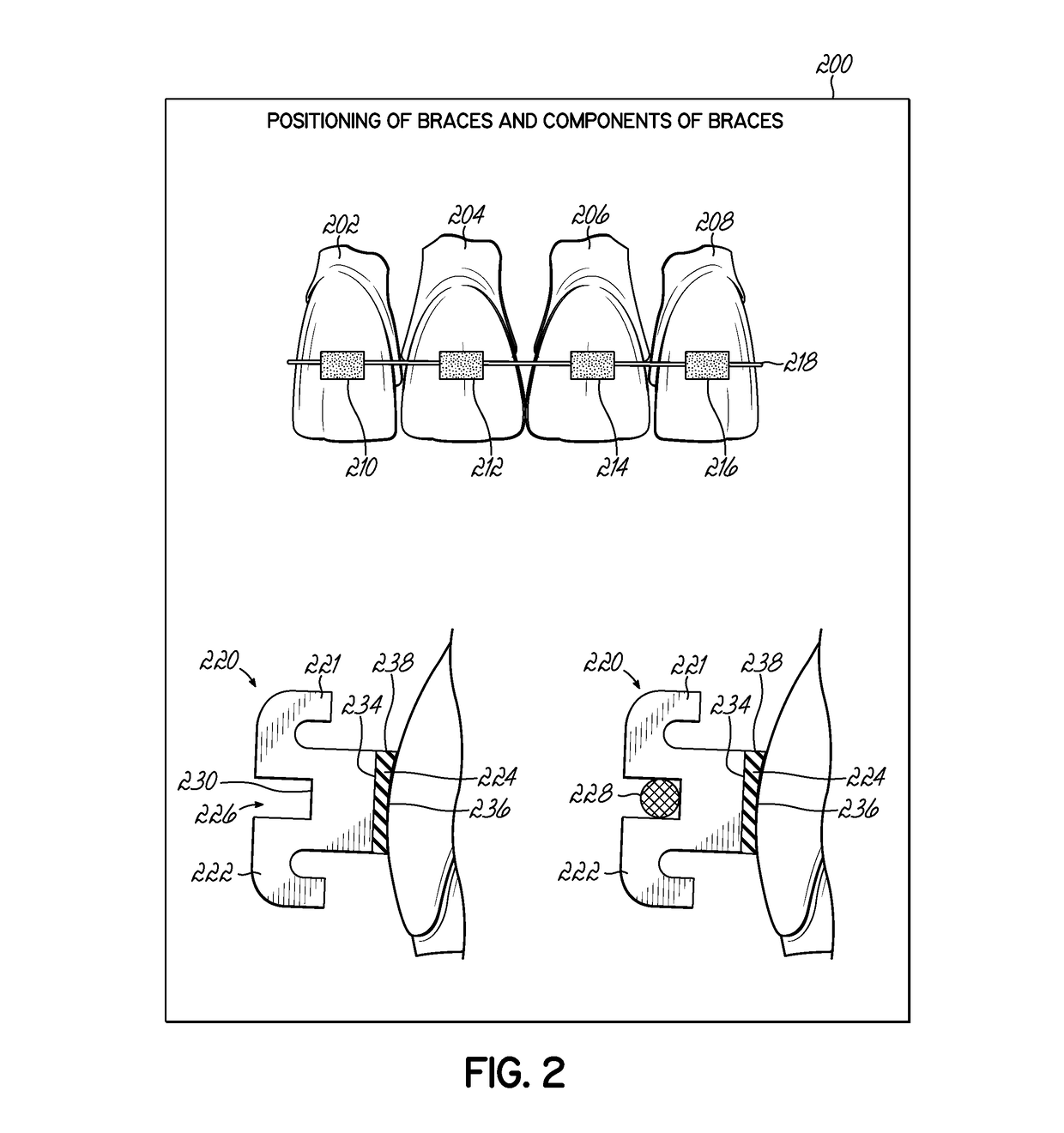 Constrained optimization of orthodontic bracket placement and archwire smoothing