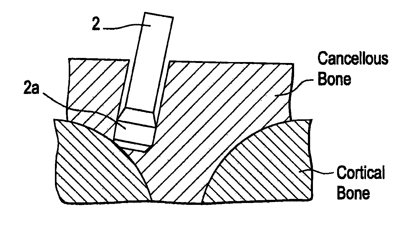 Ultrasonic horn with enlarged distal end portion