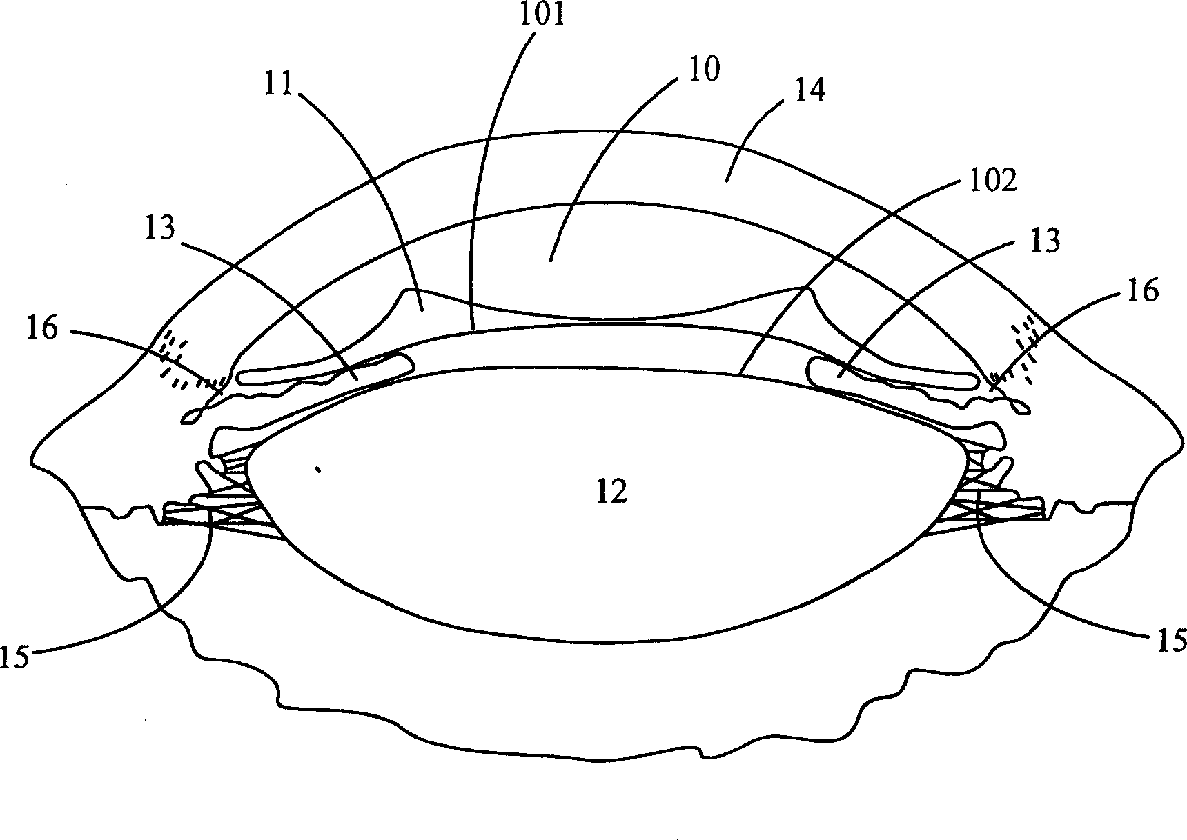 Intraocular phototropism lens and implantation method thereof