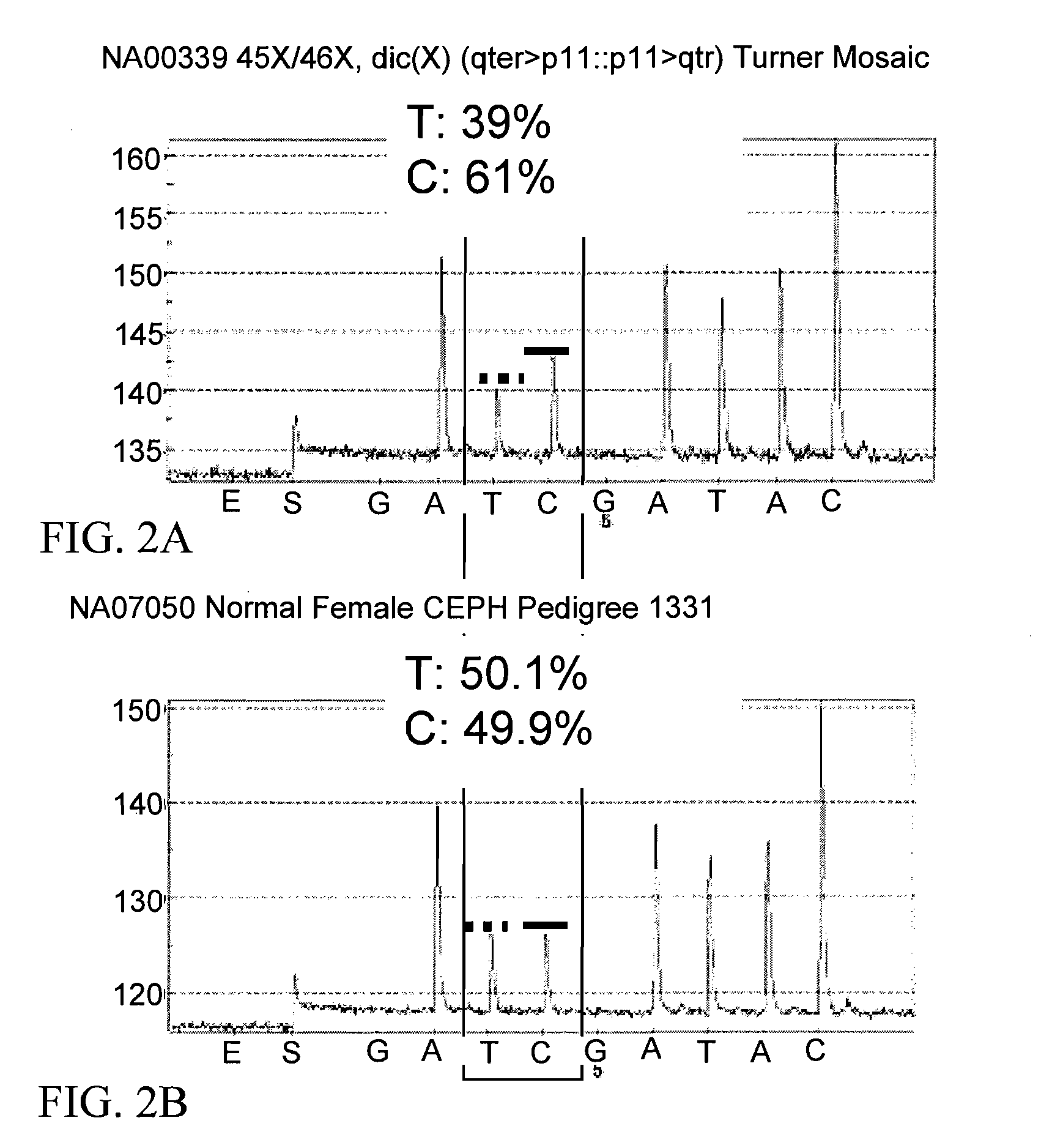 DNA Diagnostic screening for turner syndrome and sex chromosome disorders