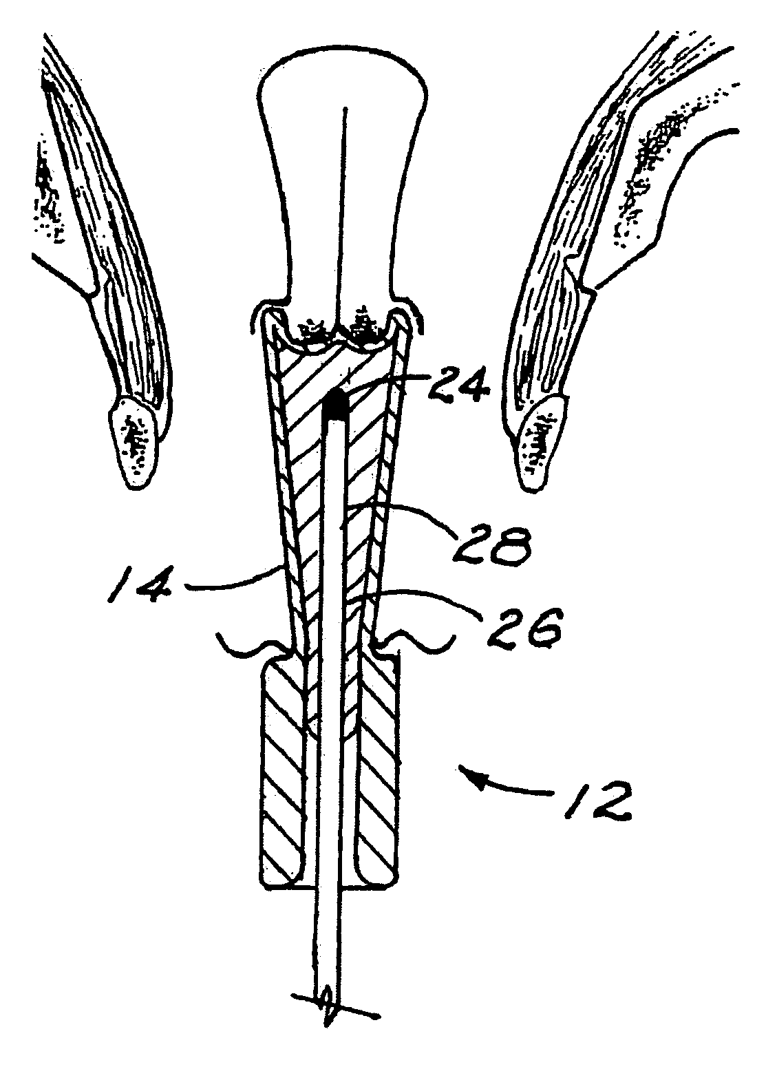 Customized gynecological brachytherapy applicator and method