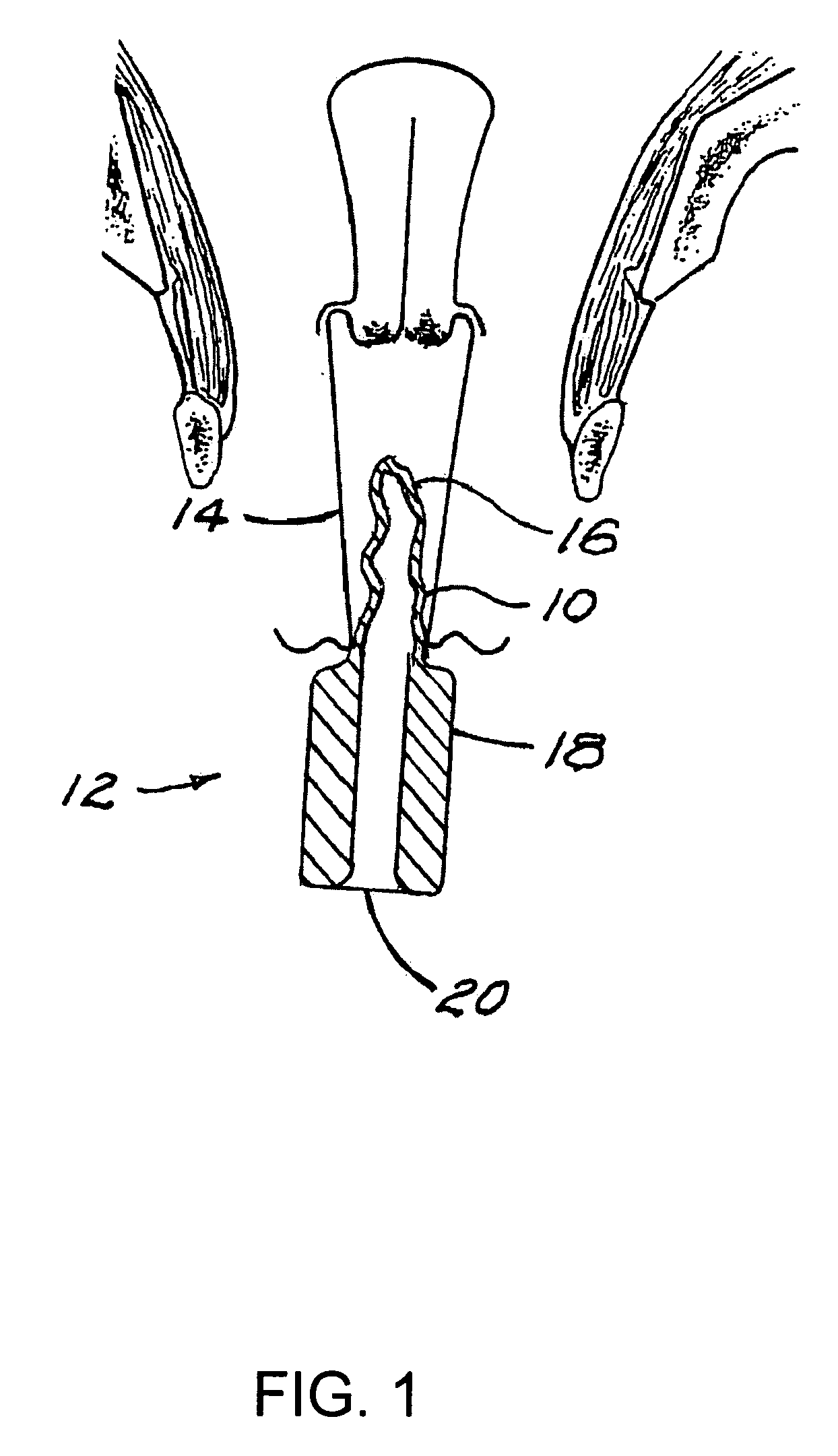 Customized gynecological brachytherapy applicator and method