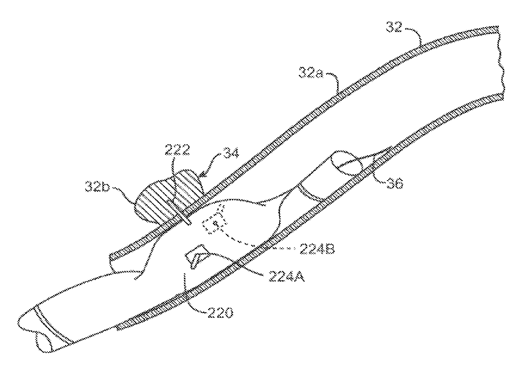 Systems and methods of treating malacia by local delivery of hydrogel to augment tissue