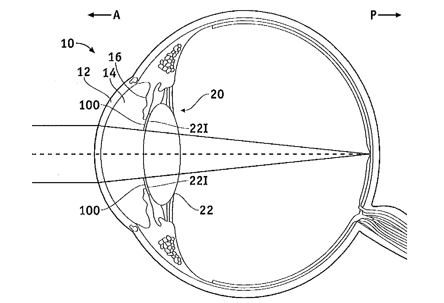 Capsular membrane implants to increase accommodative amplitude