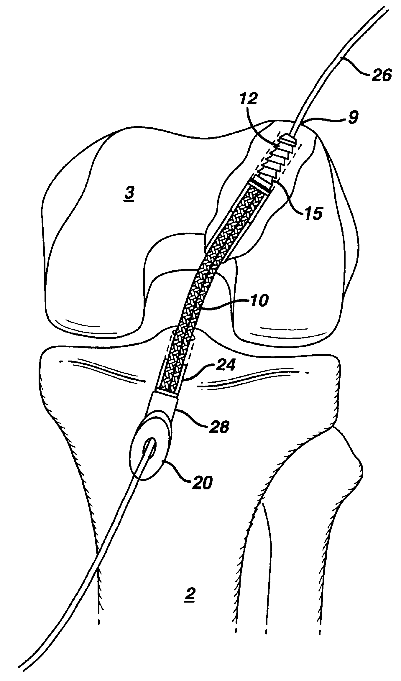 Method for anchoring autologous or artificial tendon grafts in bone